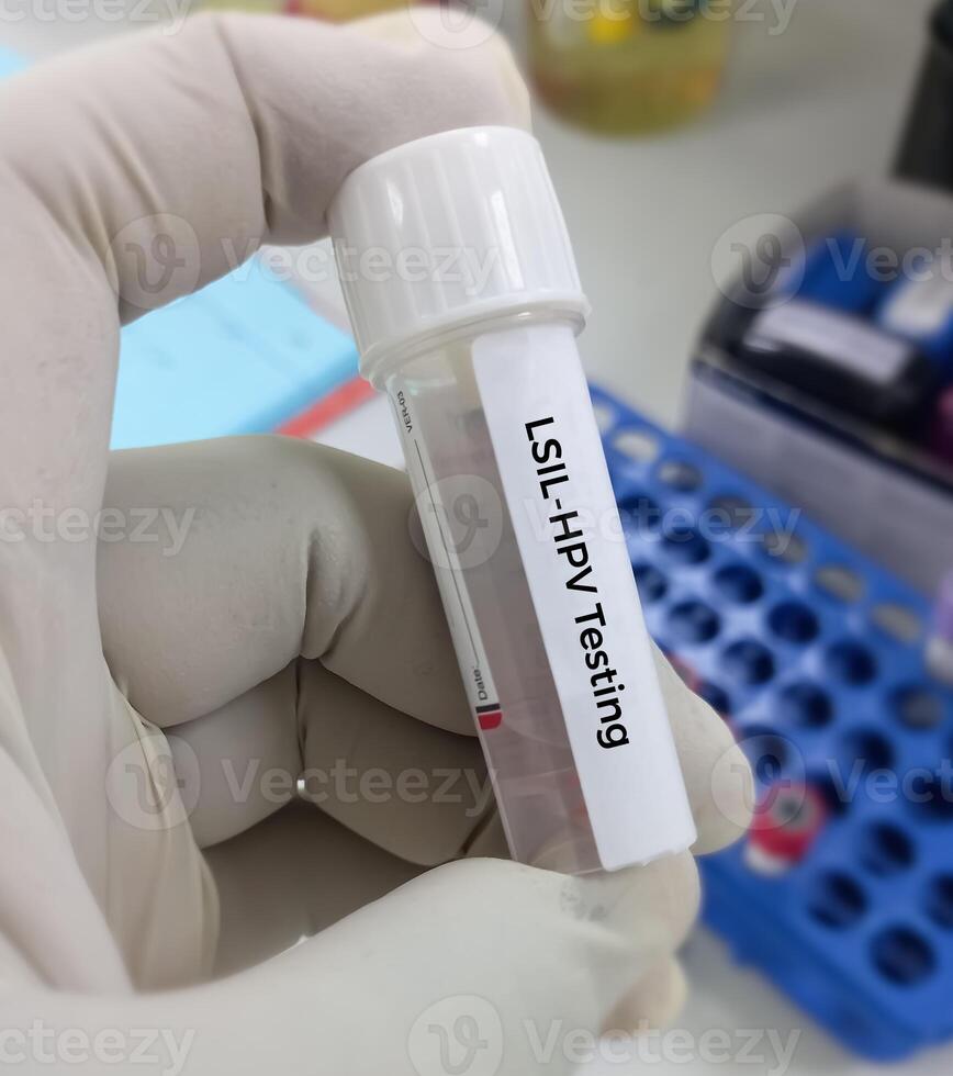 Vaginal fluid sample for LSIL HPV DNA test, Human papilloma virus, cervical cancer. A medical testing concept in the laboratory photo