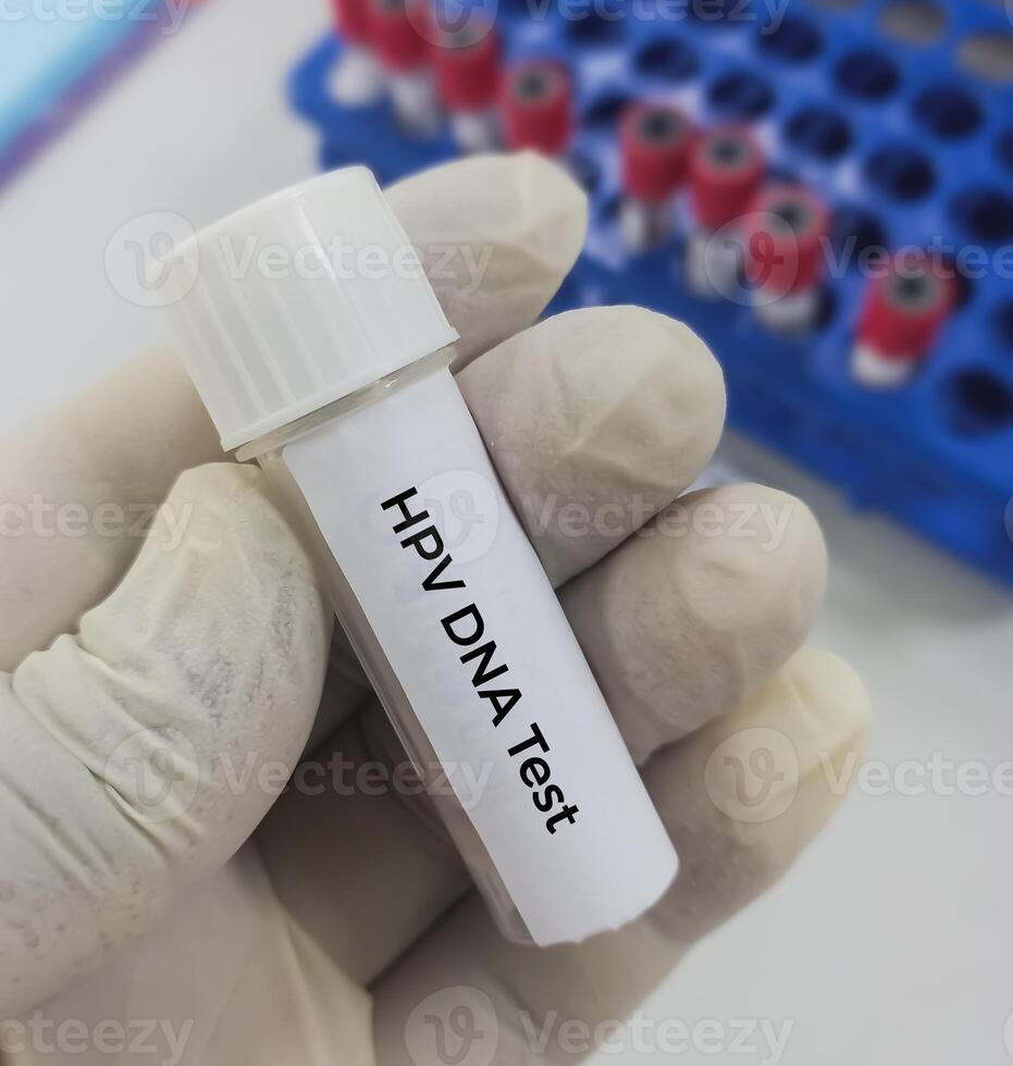 Testing tube with vaginal fluid sample for HPV DNA test, Human papilloma virus, cervical cancer. A medical testing concept in the laboratory photo