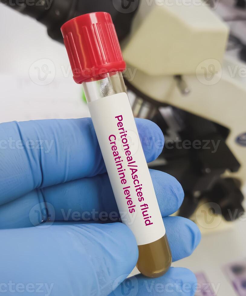 Medical technologist hold peritoneal fluid sample for peritoneal fluid Creatinine levels, used to detect iatrogenic urinary tract leakage in colorectal surgery. Ascites creatinine. photo