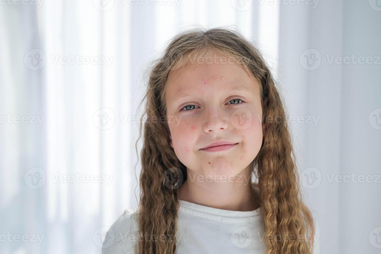 Portrait of a child with a rash from chickenpox. Girl with acne and cream on her face. photo