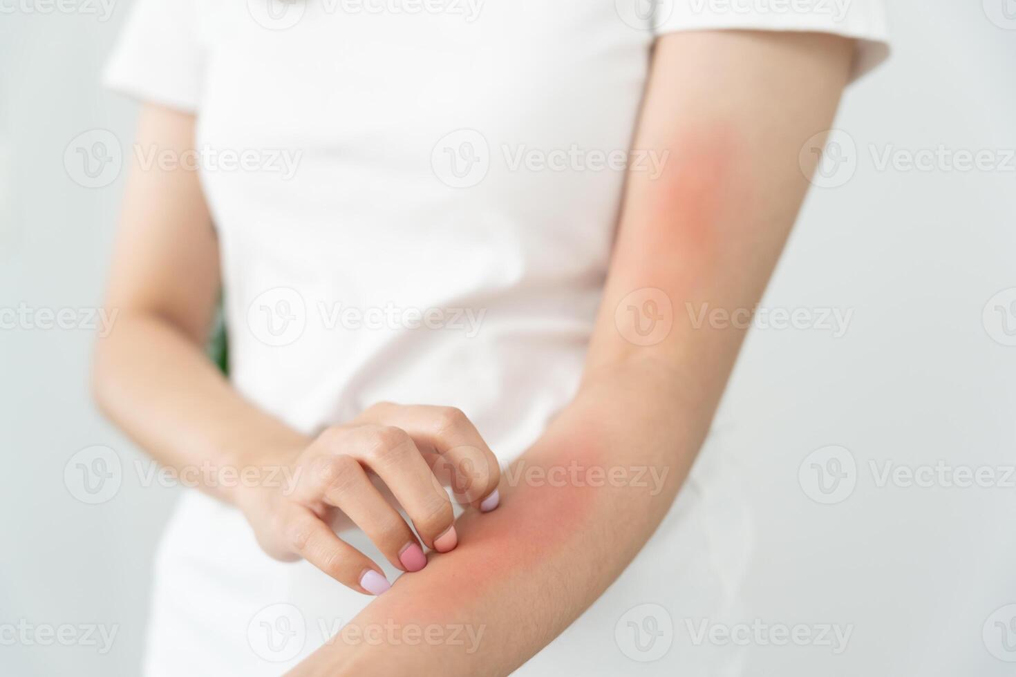 skin problem and beauty. Young woman scratch body has itchy skin from skin allergic, steroid allergy, sensitive skin, red from sunburn, chemical allergy, rash, insect bites, Seborrheic Dermatitis. photo