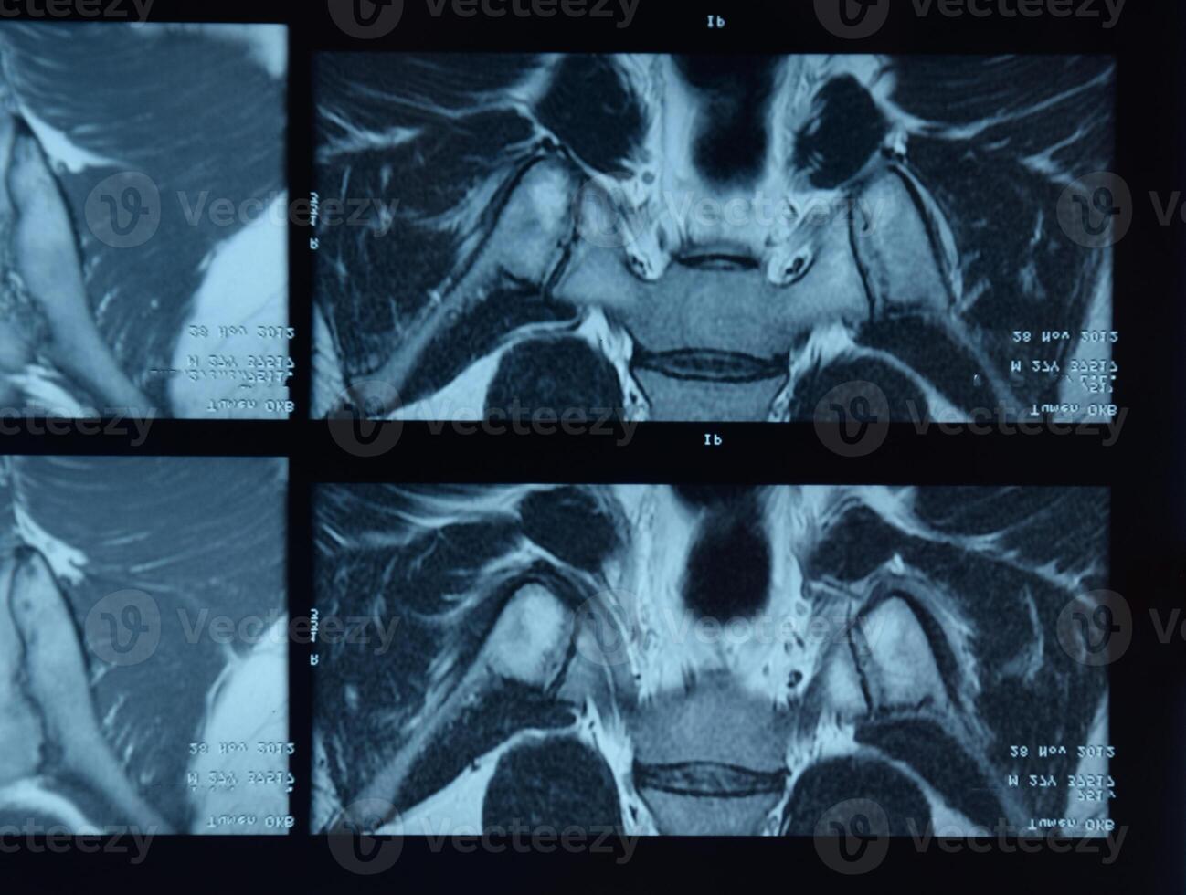 MRI sacroiliac articulation. Study of ankylosing spondyloarthritis patient. photo