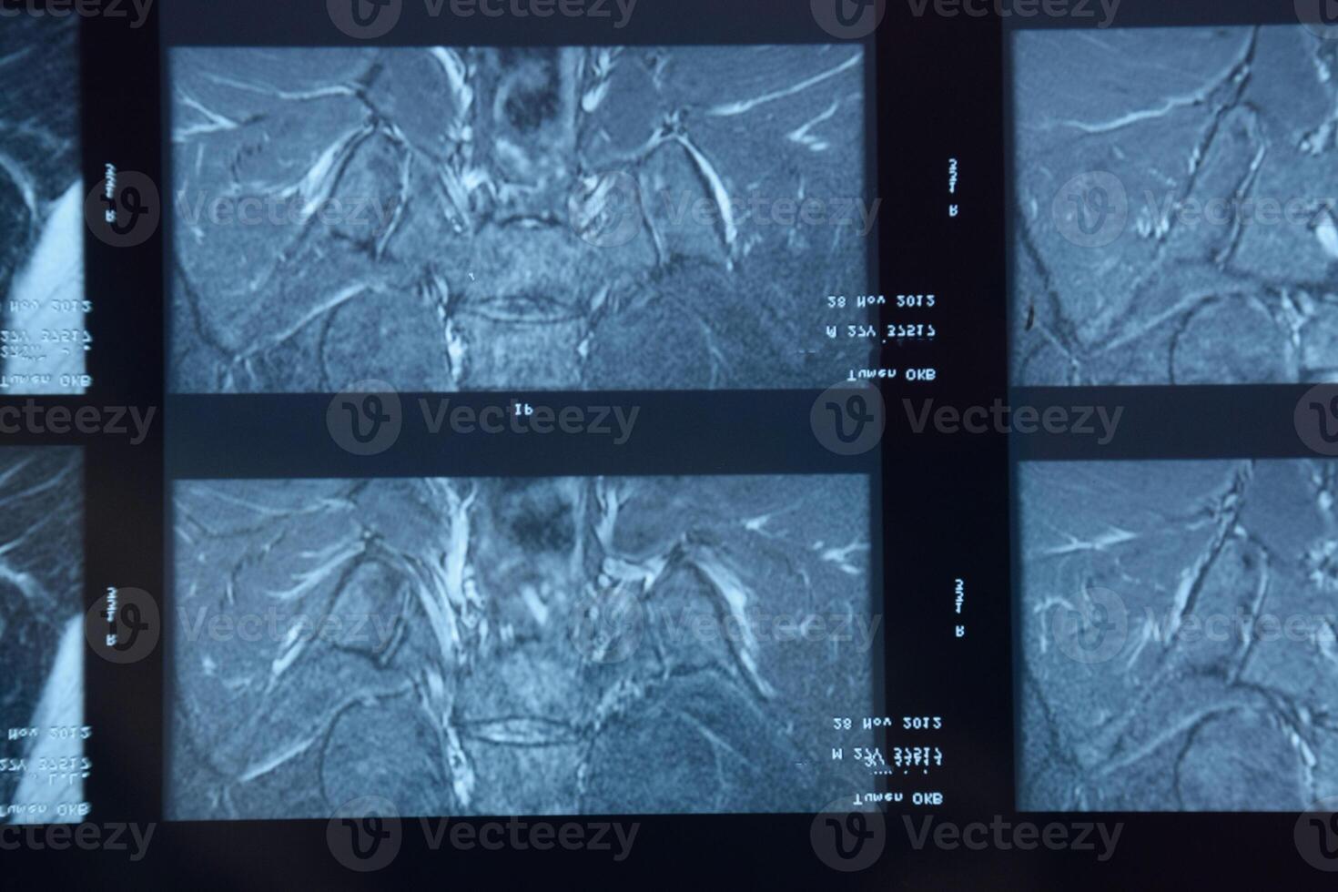 mri sacroilíaca articulación. estudiar de anquilosante espondiloartritis paciente. foto