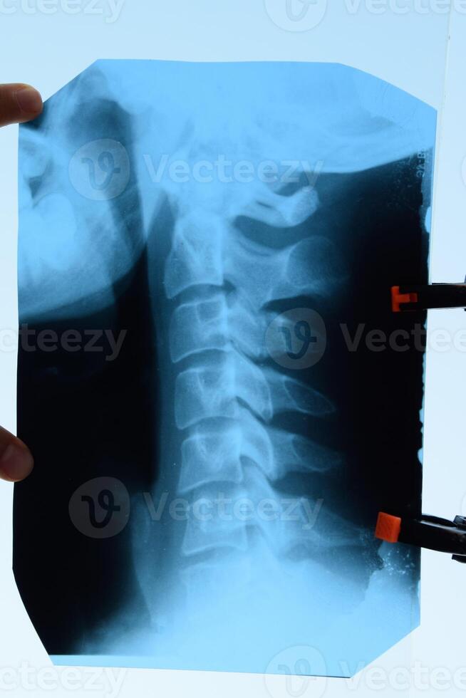 radiografía de el cervical vértebras. X rayo imagen de el cervical columna vertebral. foto