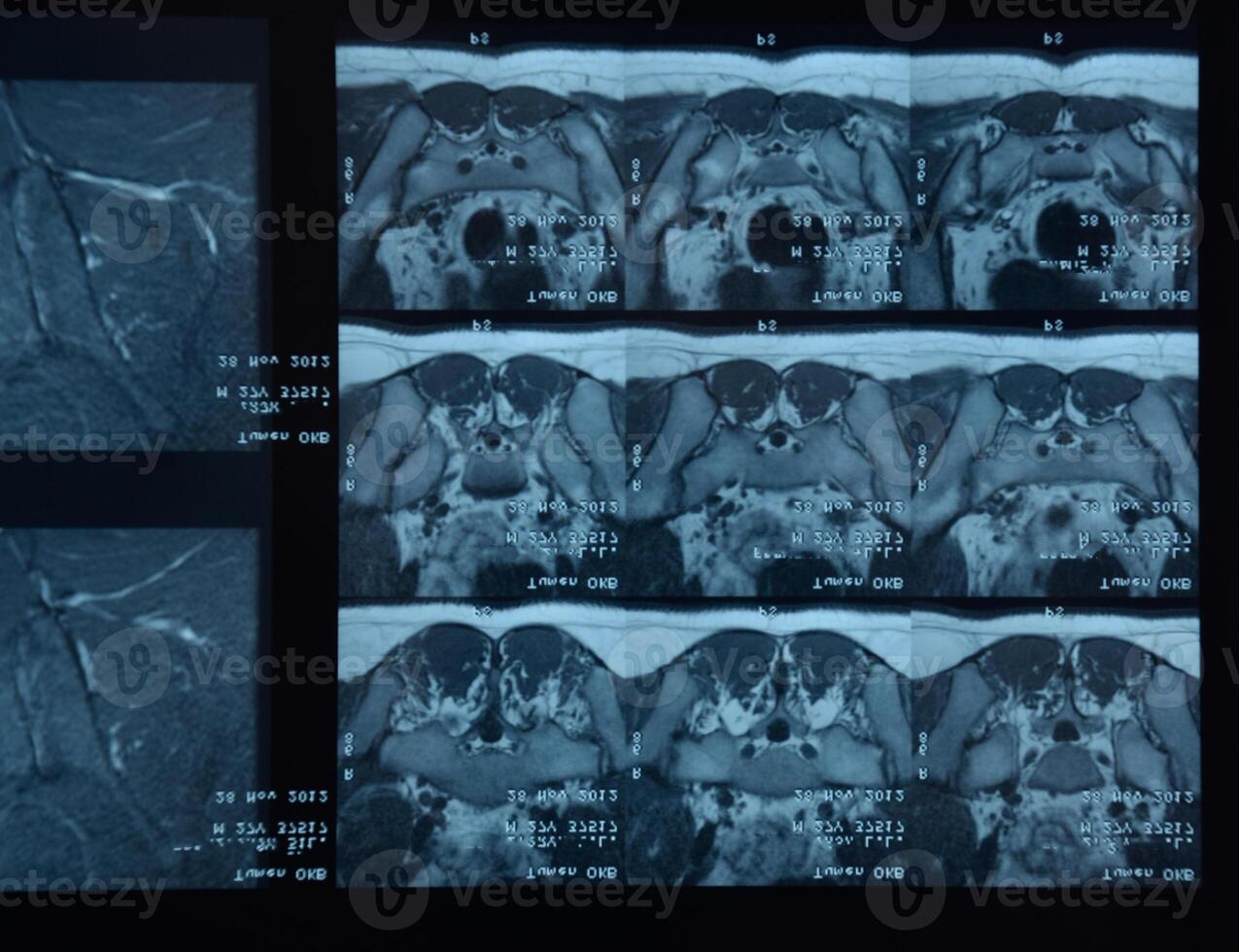 mri sacroilíaca articulación. estudiar de anquilosante espondiloartritis paciente. foto