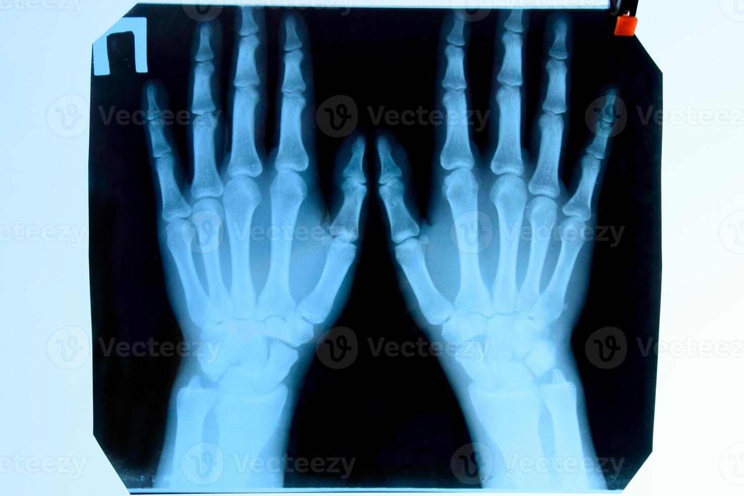 X ray of the hands, a picture of the bones of the hands on the x-ray. photo