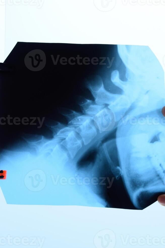 radiografía de el cervical vértebras. X rayo imagen de el cervical columna vertebral. foto