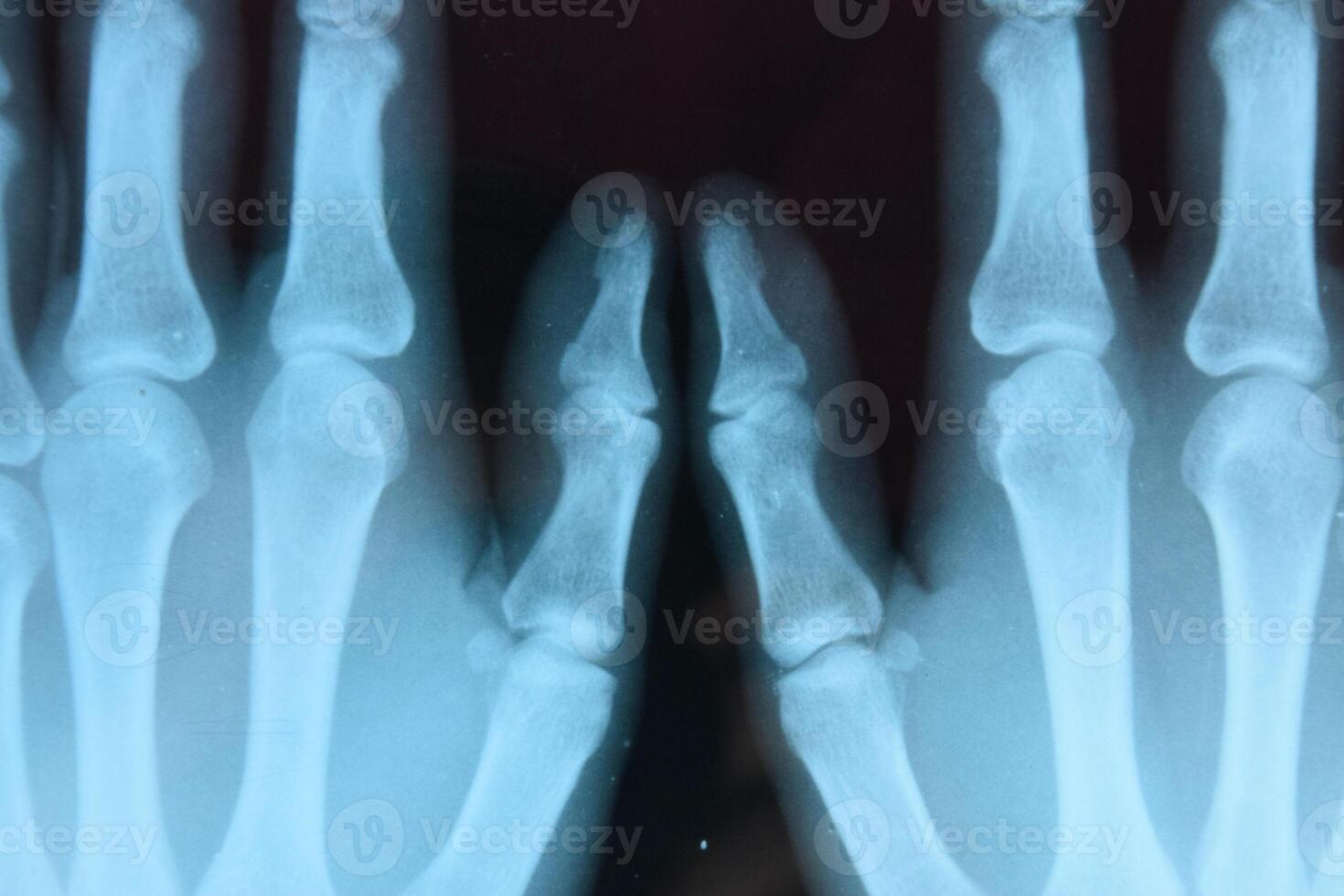 X ray of the hands, a picture of the bones of the hands on the x-ray. photo