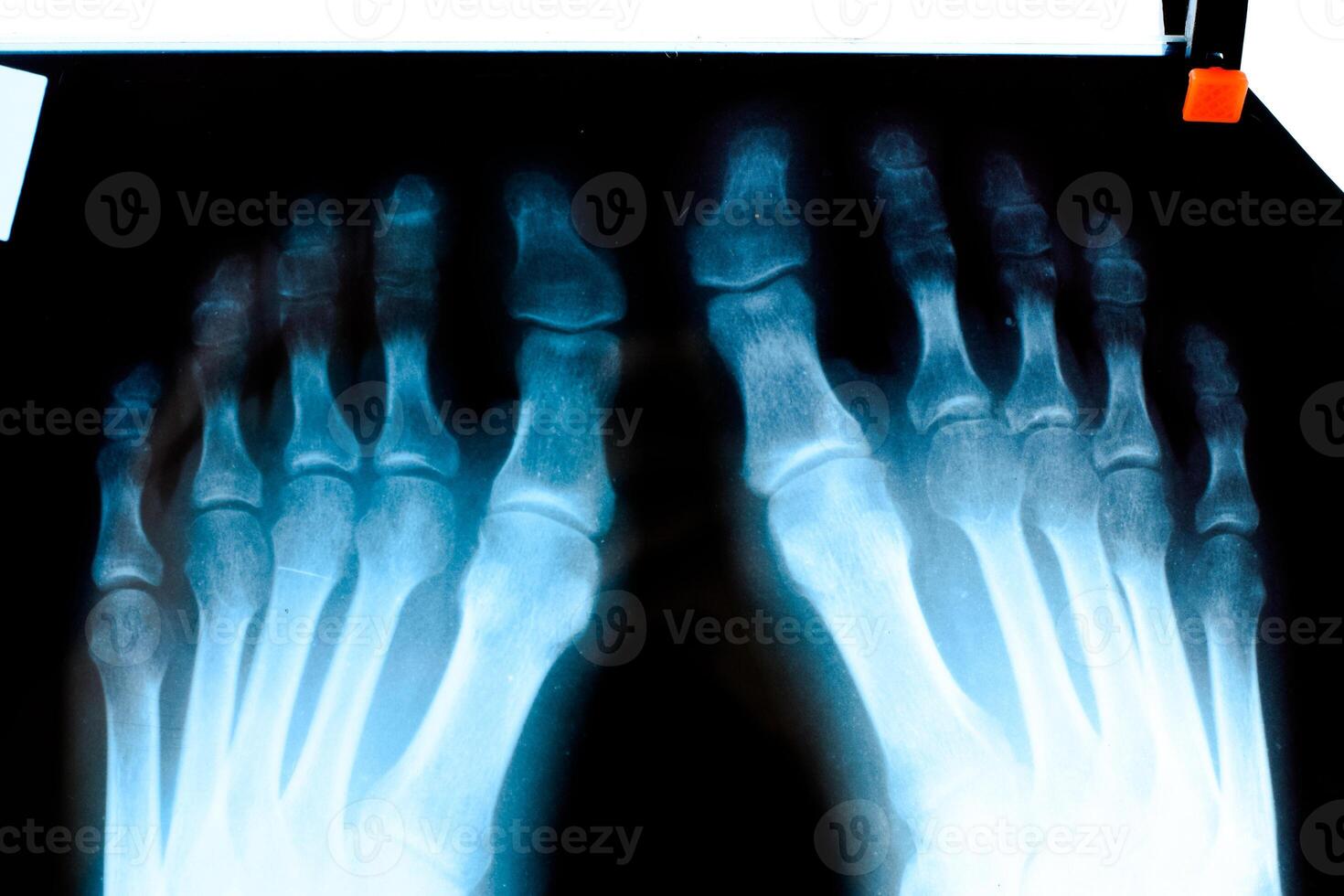 radiografía de dedos de los pies. pie en radiografía. hueso investigación foto