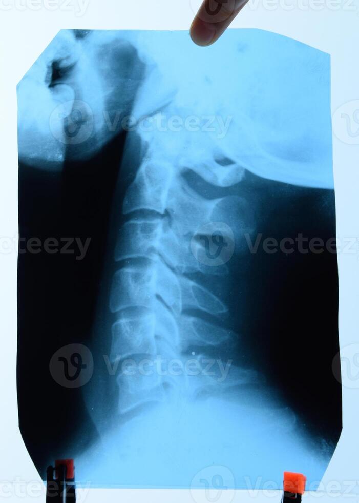 radiografía de el cervical vértebras. X rayo imagen de el cervical columna vertebral. foto