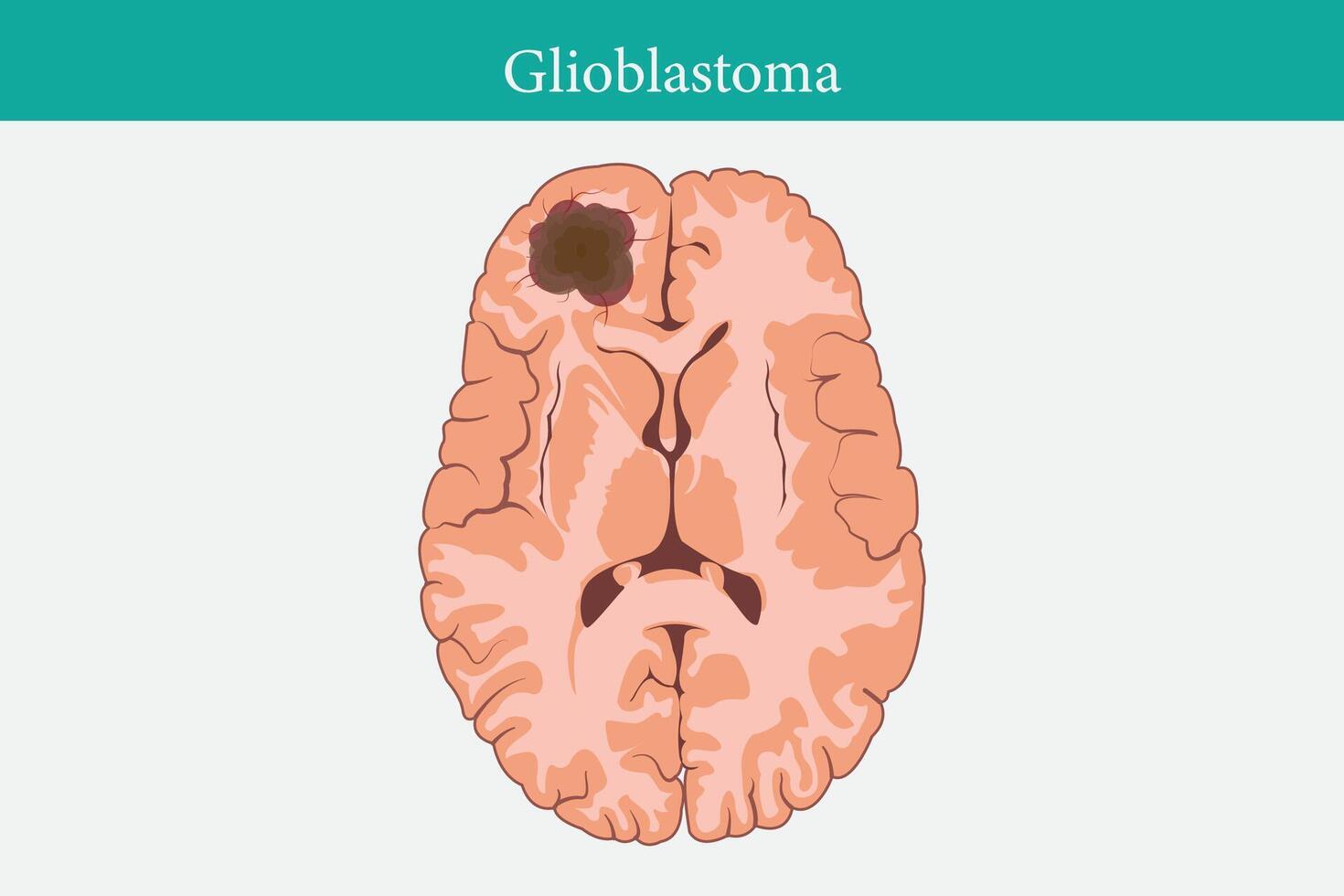 Brain cancer concept. Malignant tumor develops in the human brain. Cancer cell structure. Flat vector illustration. eps 10