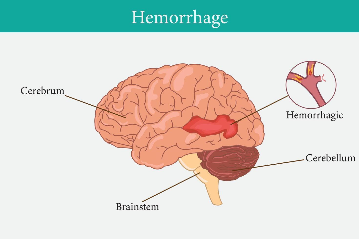 Brain cancer concept. Malignant tumor develops in the human brain. Cancer cell structure. Flat vector illustration. eps 10