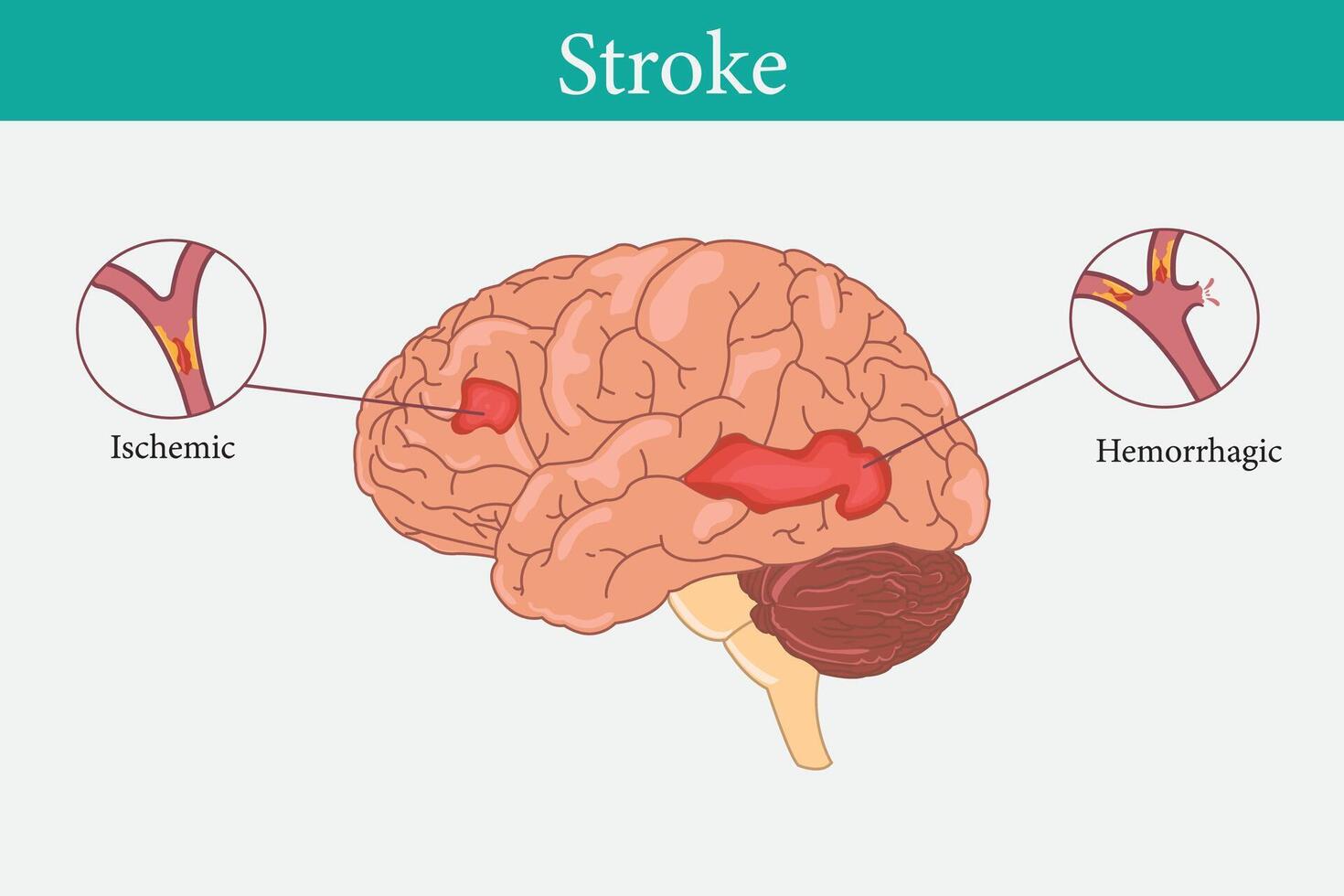 Brain cancer concept. Malignant tumor develops in the human brain. Cancer cell structure. Flat vector illustration. eps 10