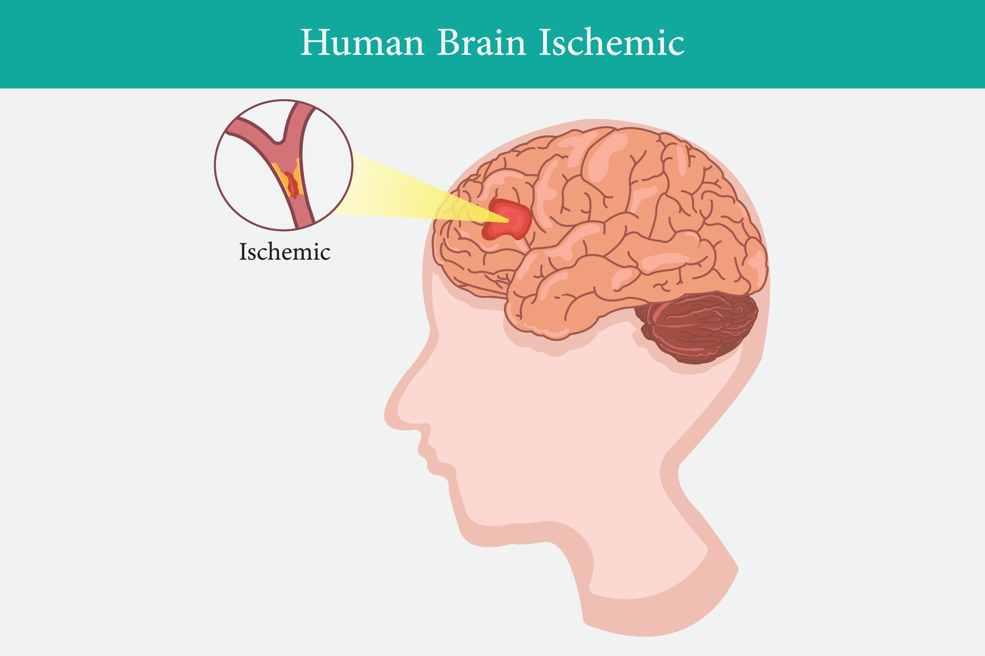 Human Anatomy Disease Ischemic Stroke Vector Illustration On White Human Anatomy Disease Ischemic Stroke Vector Illustration On White