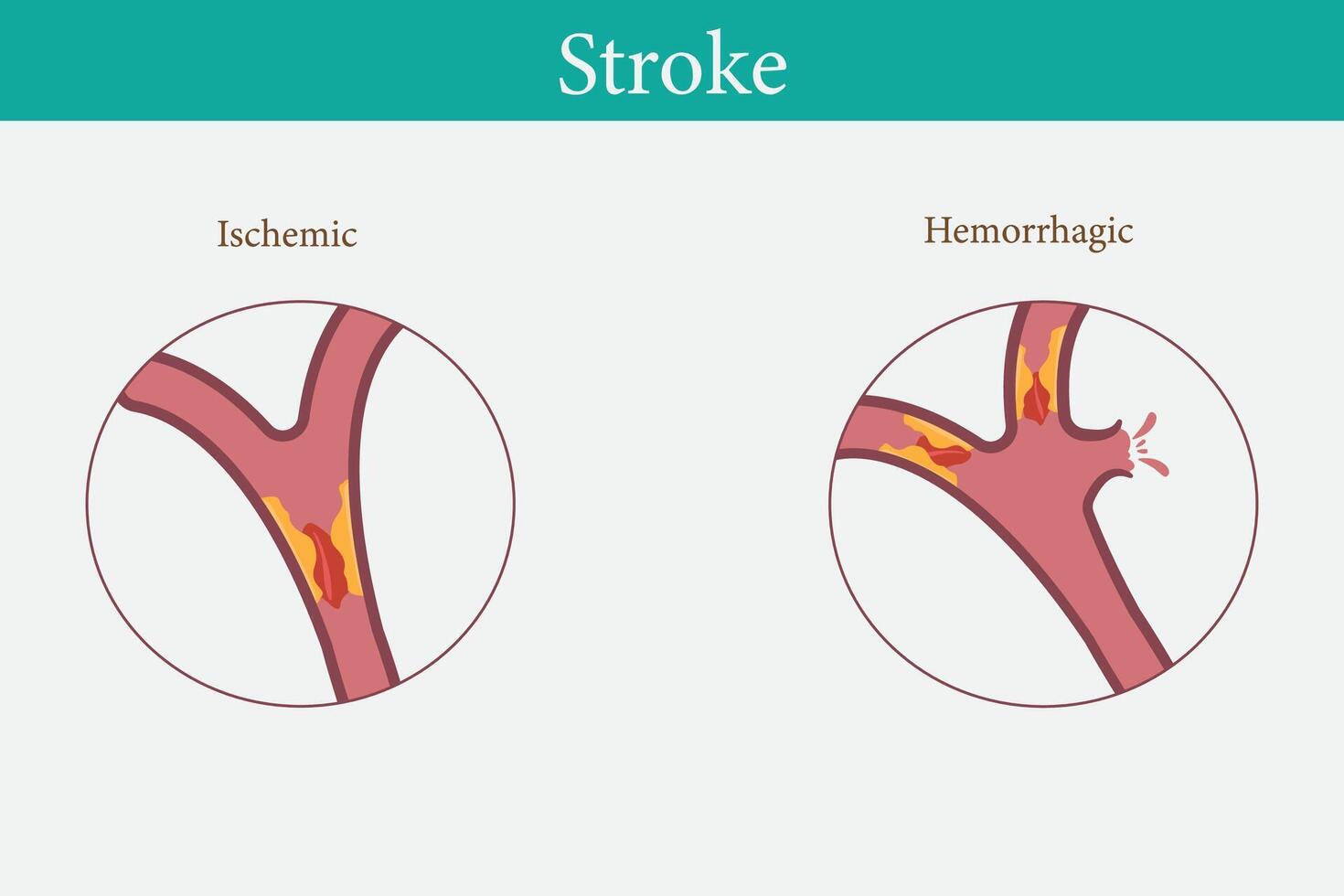 Human anatomy disease Ischemic stroke vector with hemorrhagic stroke illustration on white background