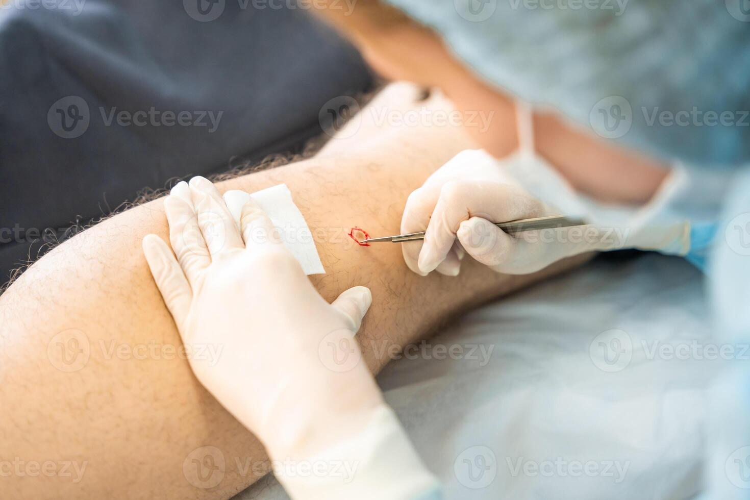 Dermatologist surgeon removes skin diseases with scalpel, operation process photo