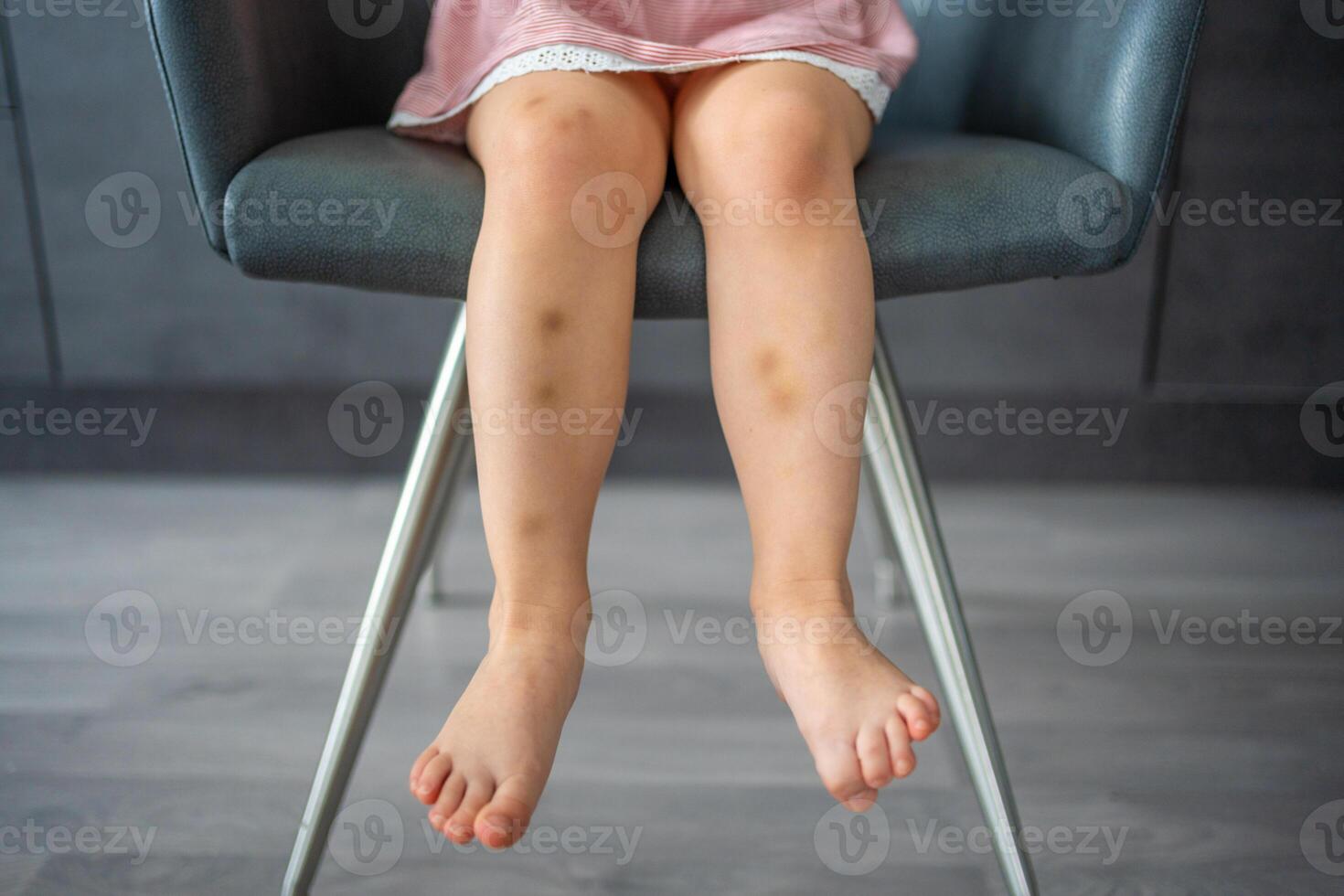 Close up of stains bruise wound on legs of little girl. Extravasation blue, purple on skin. Active childhood concept photo