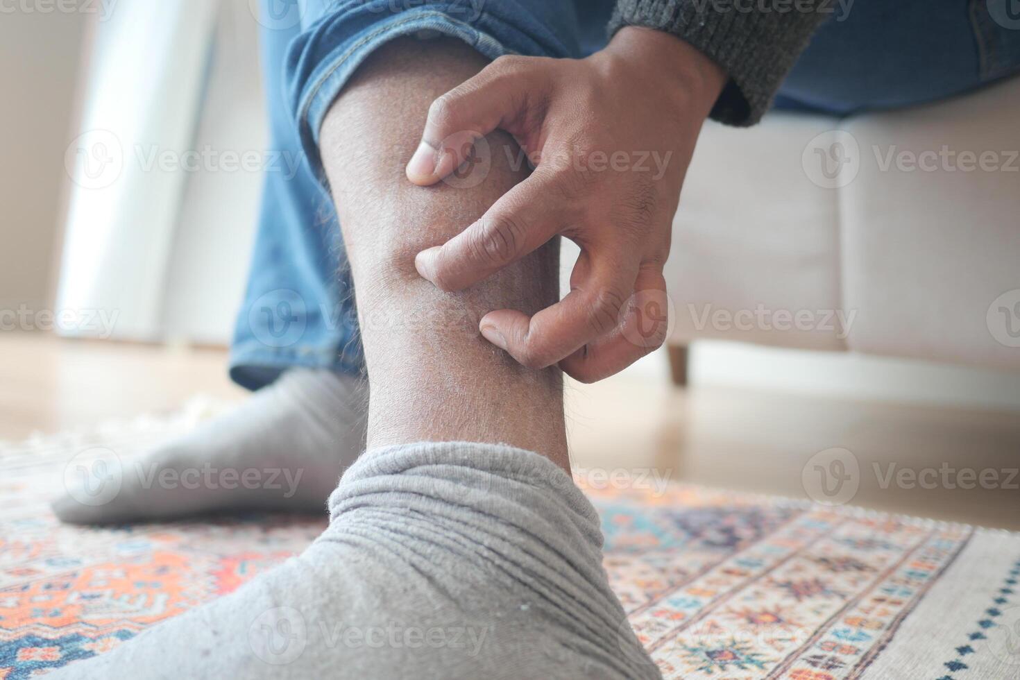 man suffering from itching skin on his feet photo