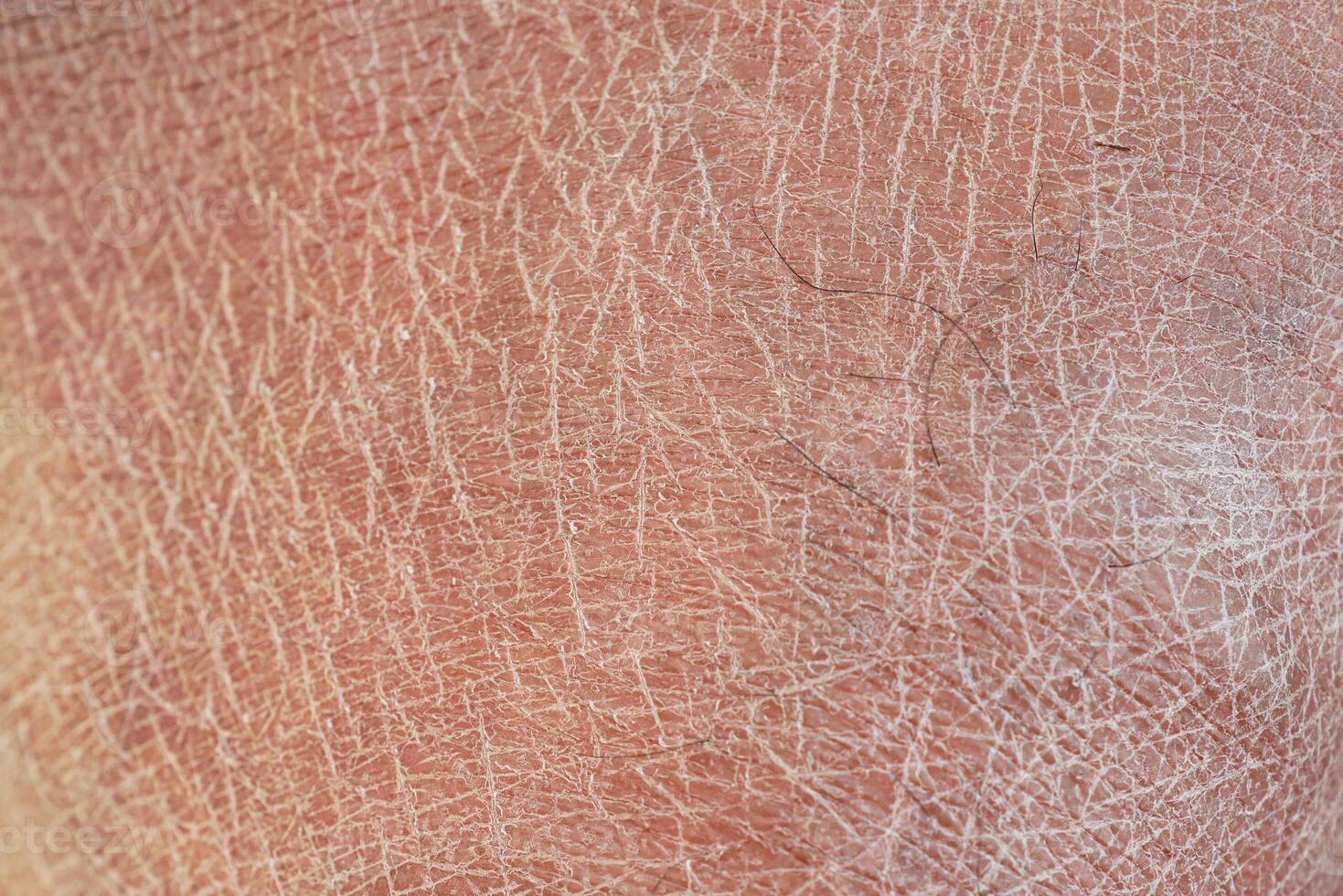 Closeup view of dry human skin . photo