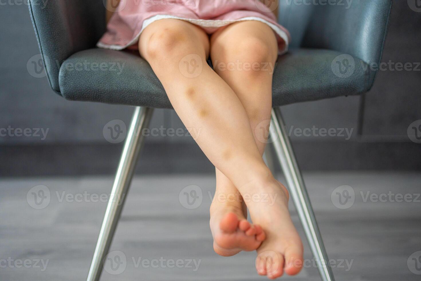 Close up of stains bruise wound on legs of little girl. Extravasation blue, purple on skin. Active childhood concept photo