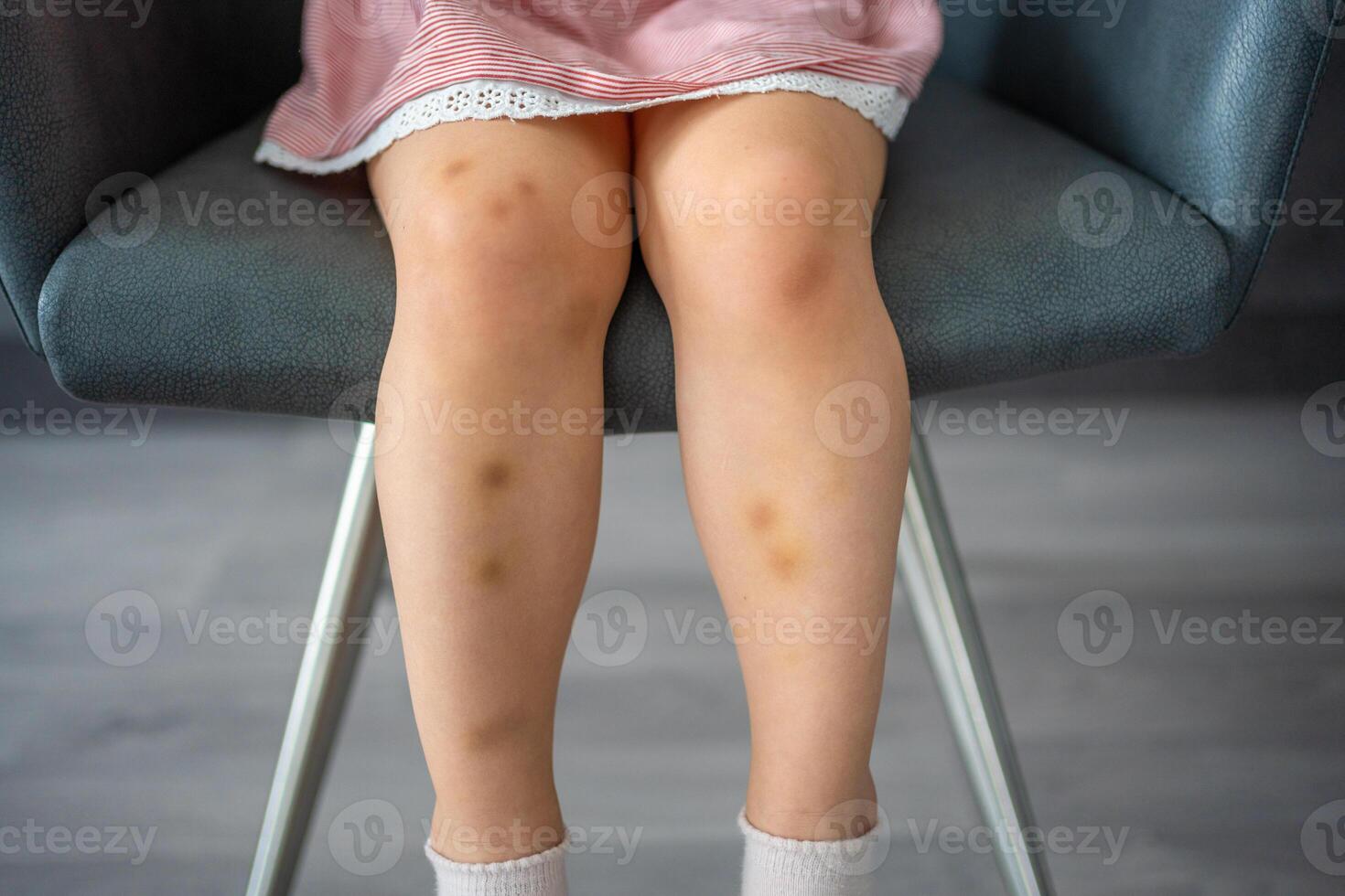 cerca arriba de manchas moretón herida en piernas de pequeño muchacha. extravasación azul, púrpura en piel. activo infancia concepto foto