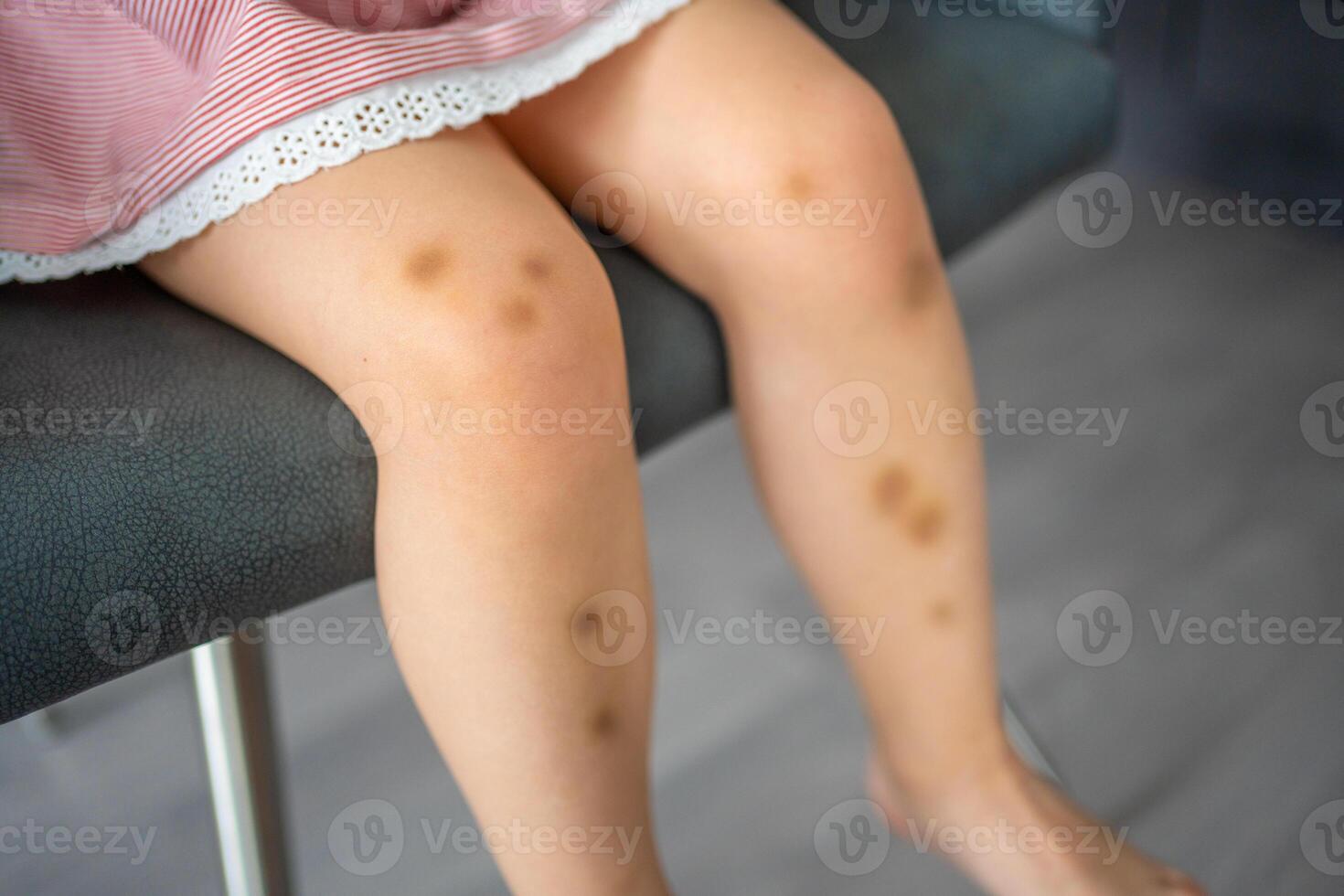Close up of stains bruise wound on legs of little girl. Extravasation blue, purple on skin. Active childhood concept photo