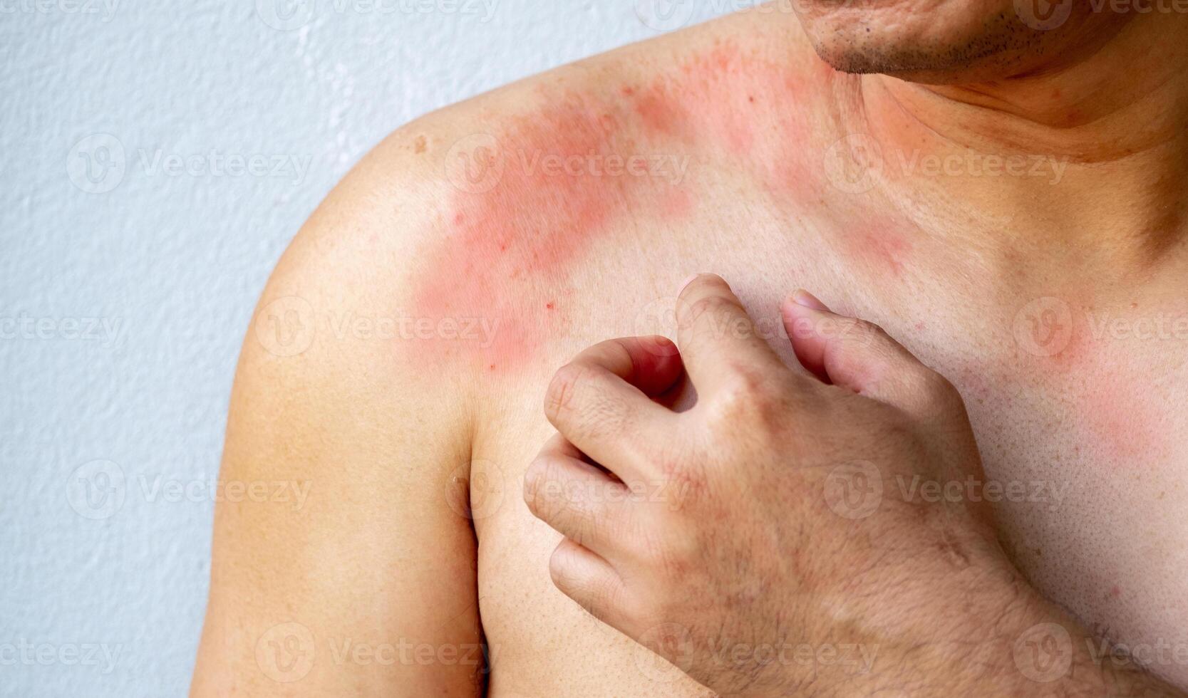 Close up Hand of a man scratching with itchy skin on the body on the chest or shoulde, itching due to rash, fungus, allergy, dermatological disease, dry skin. Healthcare and medical concept. photo