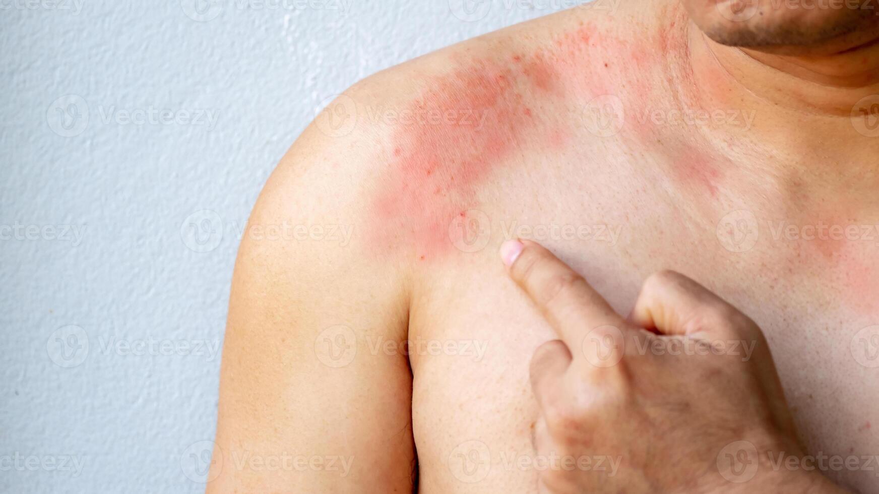 Close up Hand of a man poiting with itchy skin on the body on the chest or shoulde, itching due to rash, fungus, allergy, dermatological disease, dry skin. Healthcare and medical concept. photo
