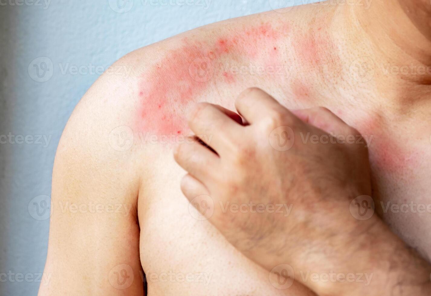 Close up Hand of a man scratching with itchy skin on the body on the chest or shoulde, itching due to rash, fungus, allergy, dermatological disease, dry skin. Healthcare and medical concept. photo