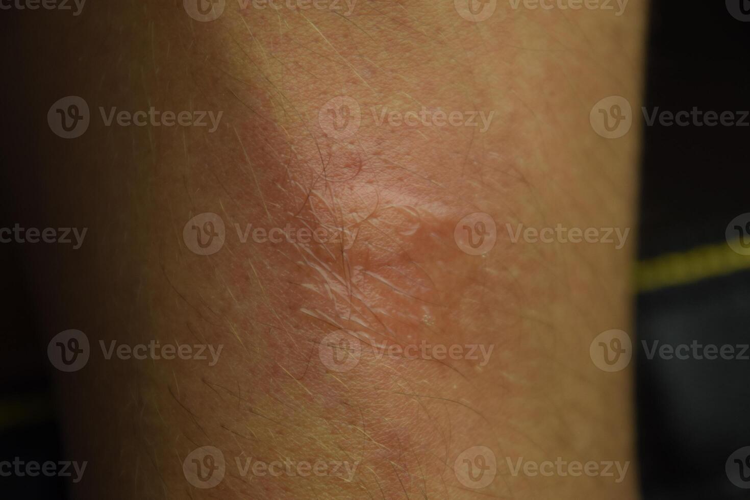 Allergy skin. Allergic reactions on the skin in the form of swelling and redness photo