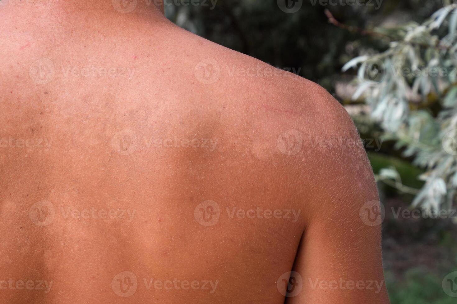 Sunburn on the skin of the back. Exfoliation, skin peels off. Dangerous sun tan photo