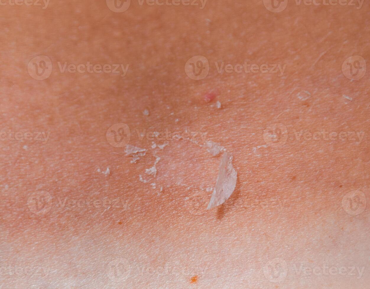 Sunburn on the skin of the back. Exfoliation, skin peels off. Dangerous sun tan photo