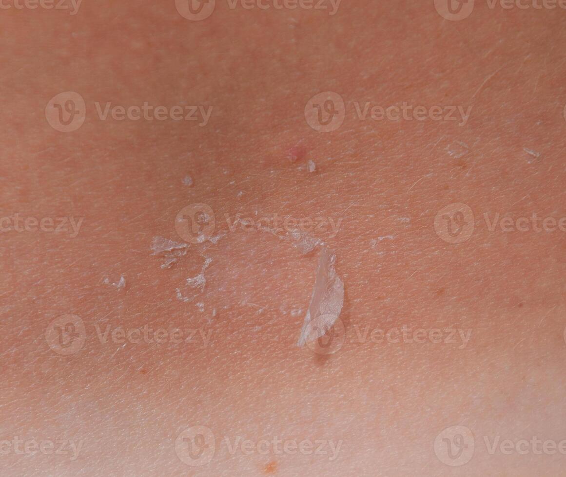 Sunburn on the skin of the back. Exfoliation, skin peels off. Dangerous sun tan photo