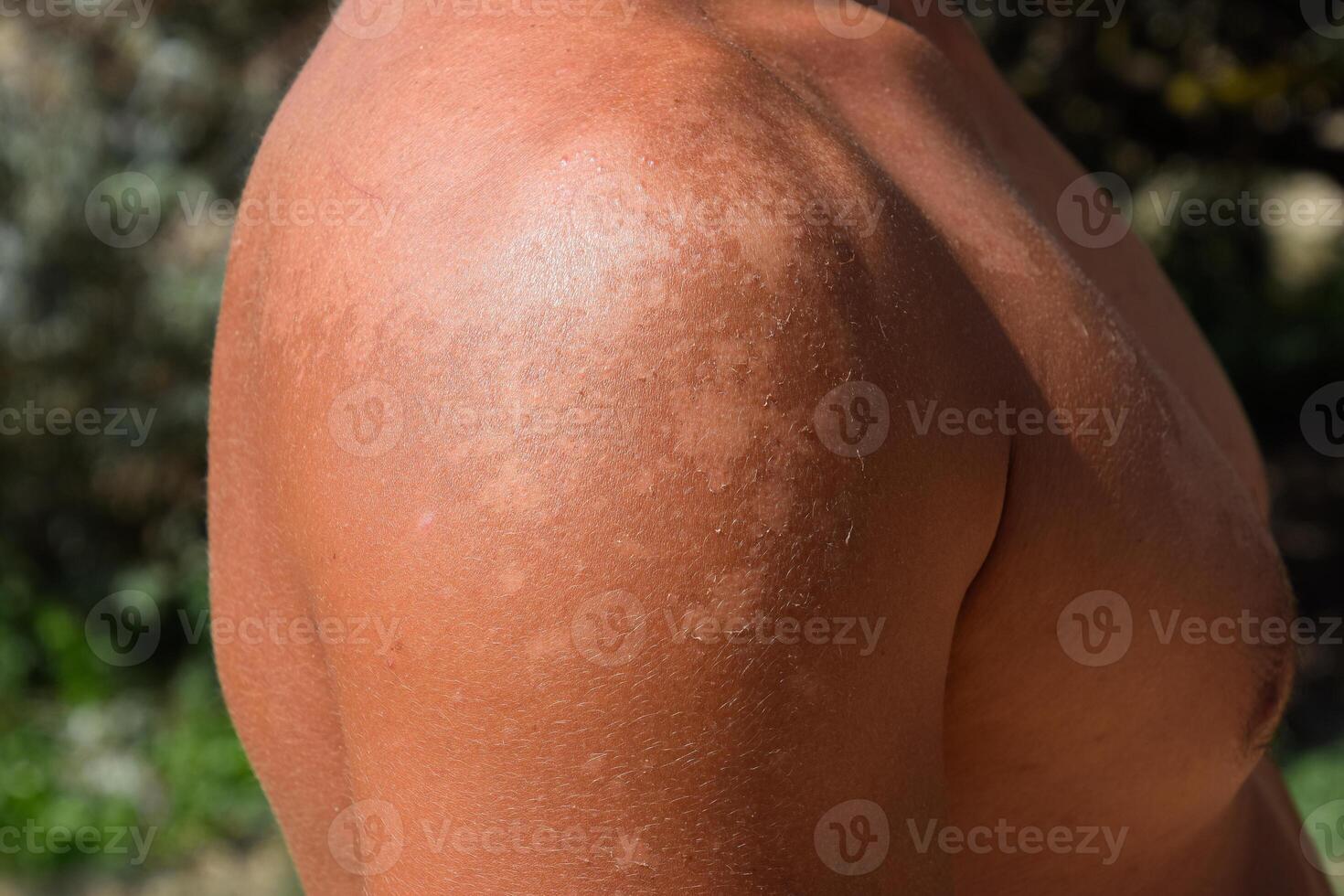 Sunburn on the skin of the shoulders. Exfoliation, skin peels off. Dangerous sun tan photo