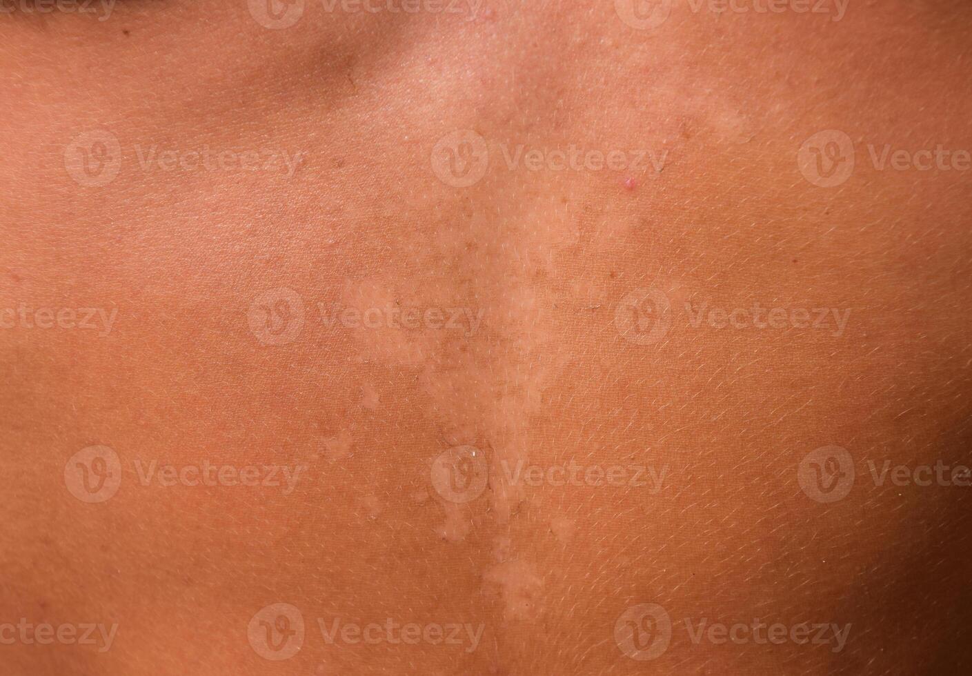 Sunburn on the skin of the stomach. Exfoliation, skin peels off. Dangerous sun tan photo