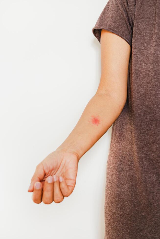 Shingles, Zoster or Herpes Zoster symptoms on womans arm isolated. photo