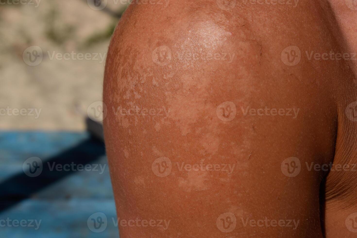 Sunburn on the skin of the shoulders. Exfoliation, skin peels off. Dangerous sun tan photo
