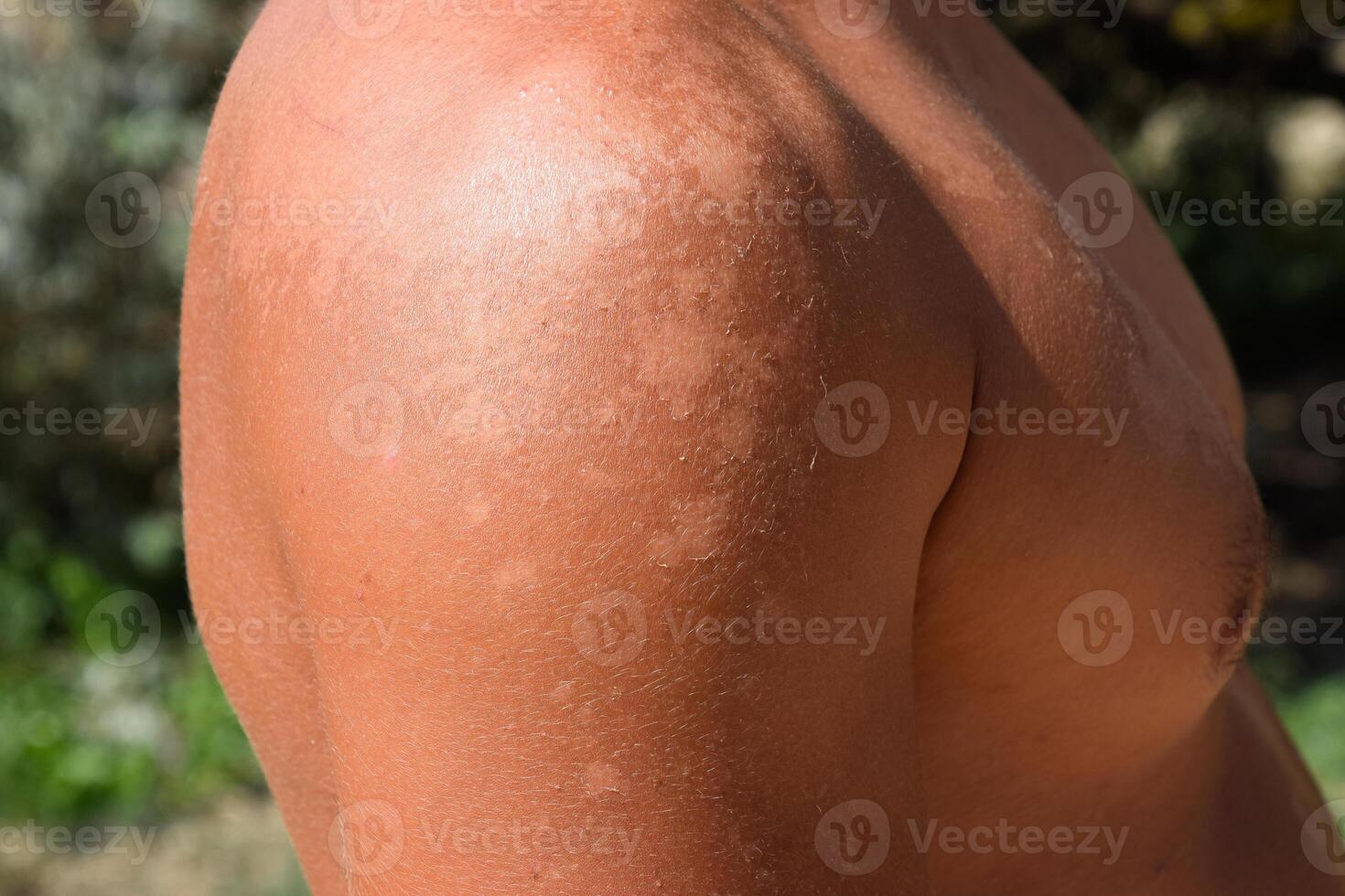 Sunburn on the skin of the shoulders. Exfoliation, skin peels off. Dangerous sun tan photo