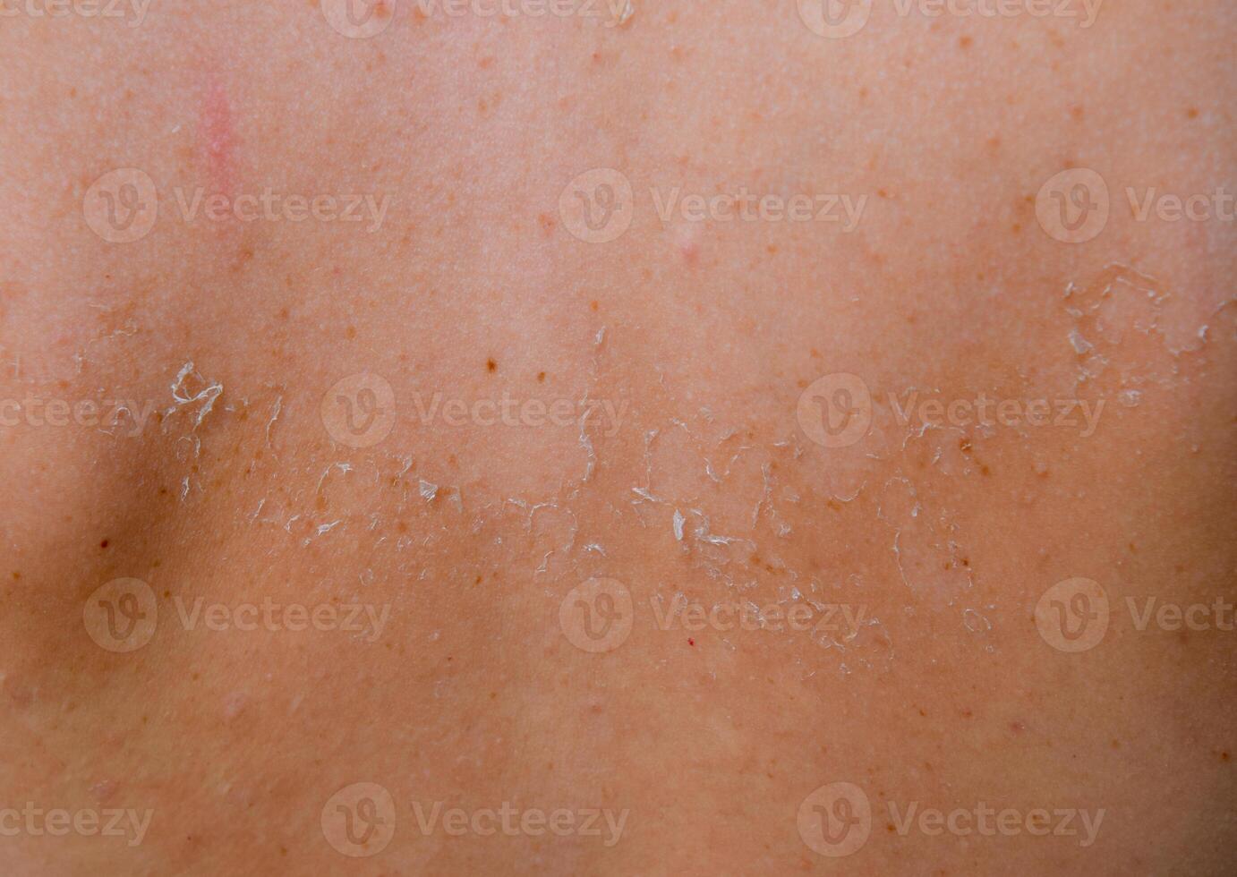 Sunburn on the skin of the back. Exfoliation, skin peels off. Dangerous sun tan photo