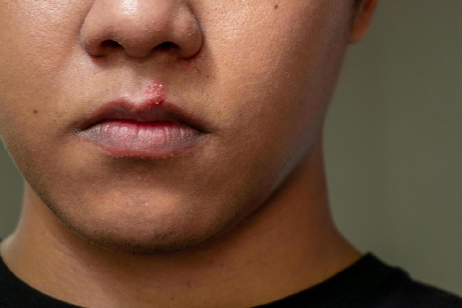 Herpes virus and infection treatment. Men lips affected  by herpes blisters photo