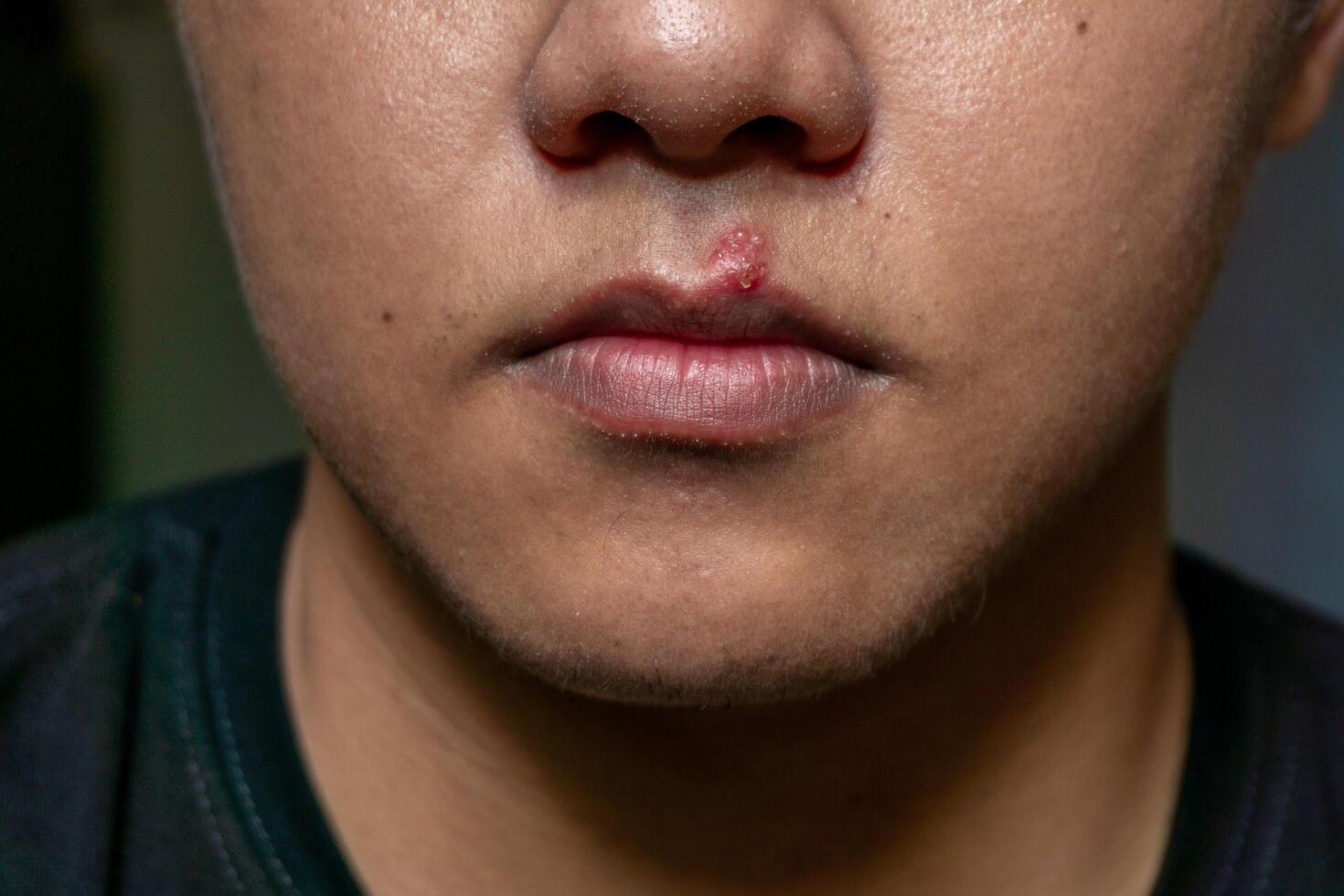 Herpes virus and infection treatment. Men lips affected  by herpes blisters photo