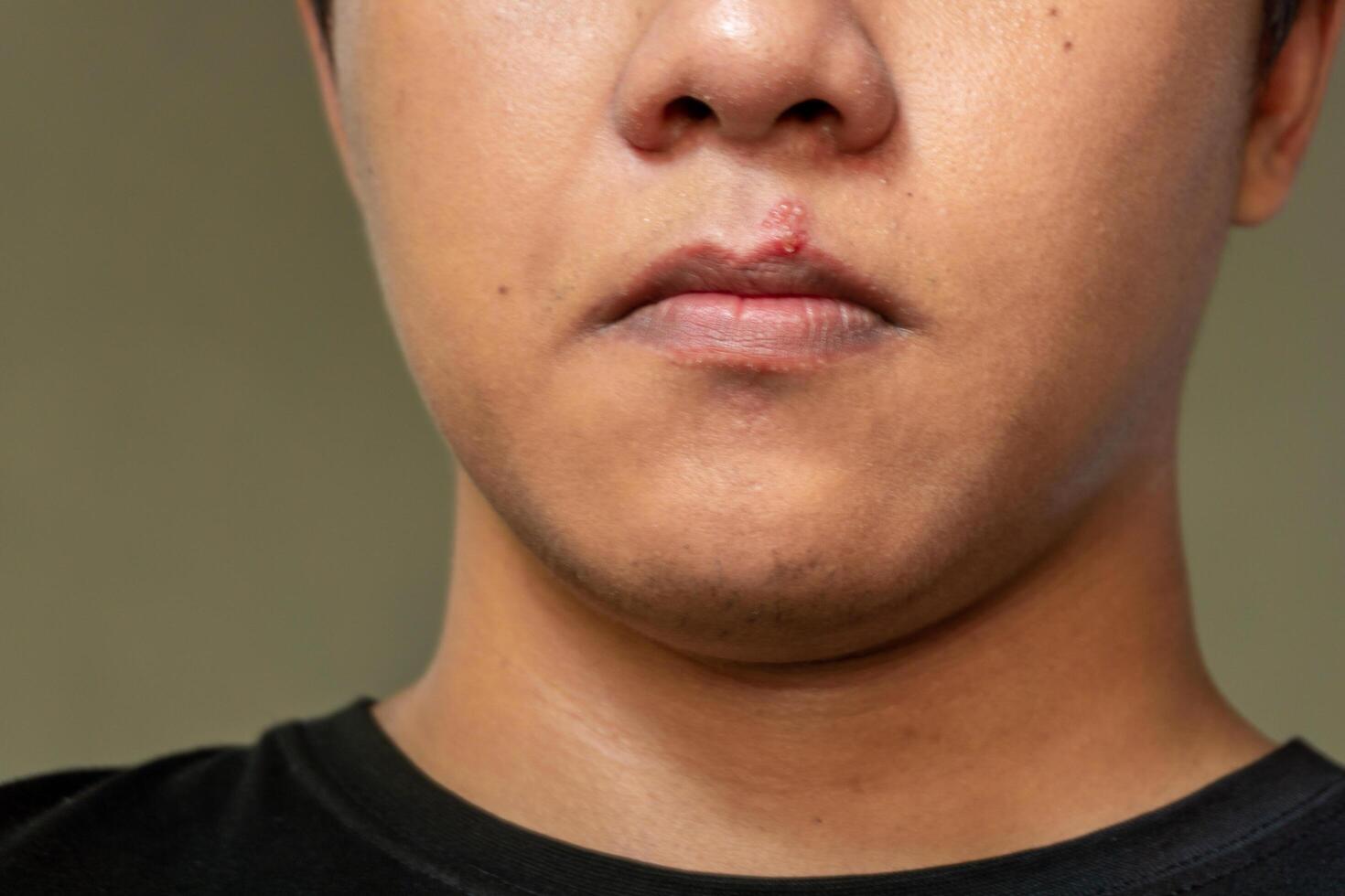 Herpes virus and infection treatment. Men lips affected  by herpes blisters photo