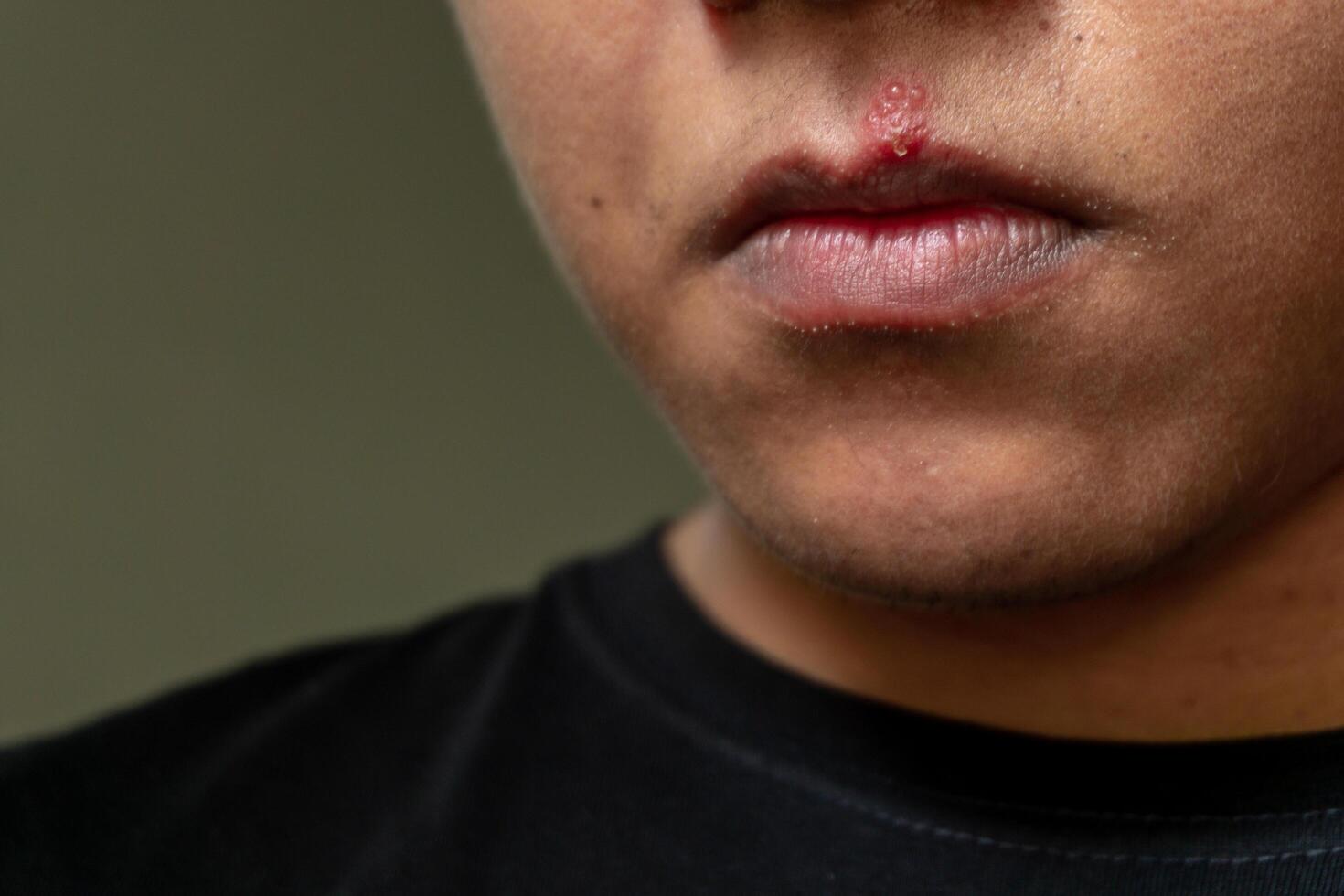 Herpes virus and infection treatment. Men lips affected  by herpes blisters photo