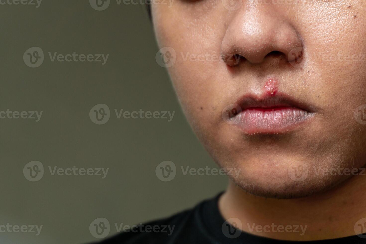 Herpes virus and infection treatment. Men lips affected  by herpes blisters photo