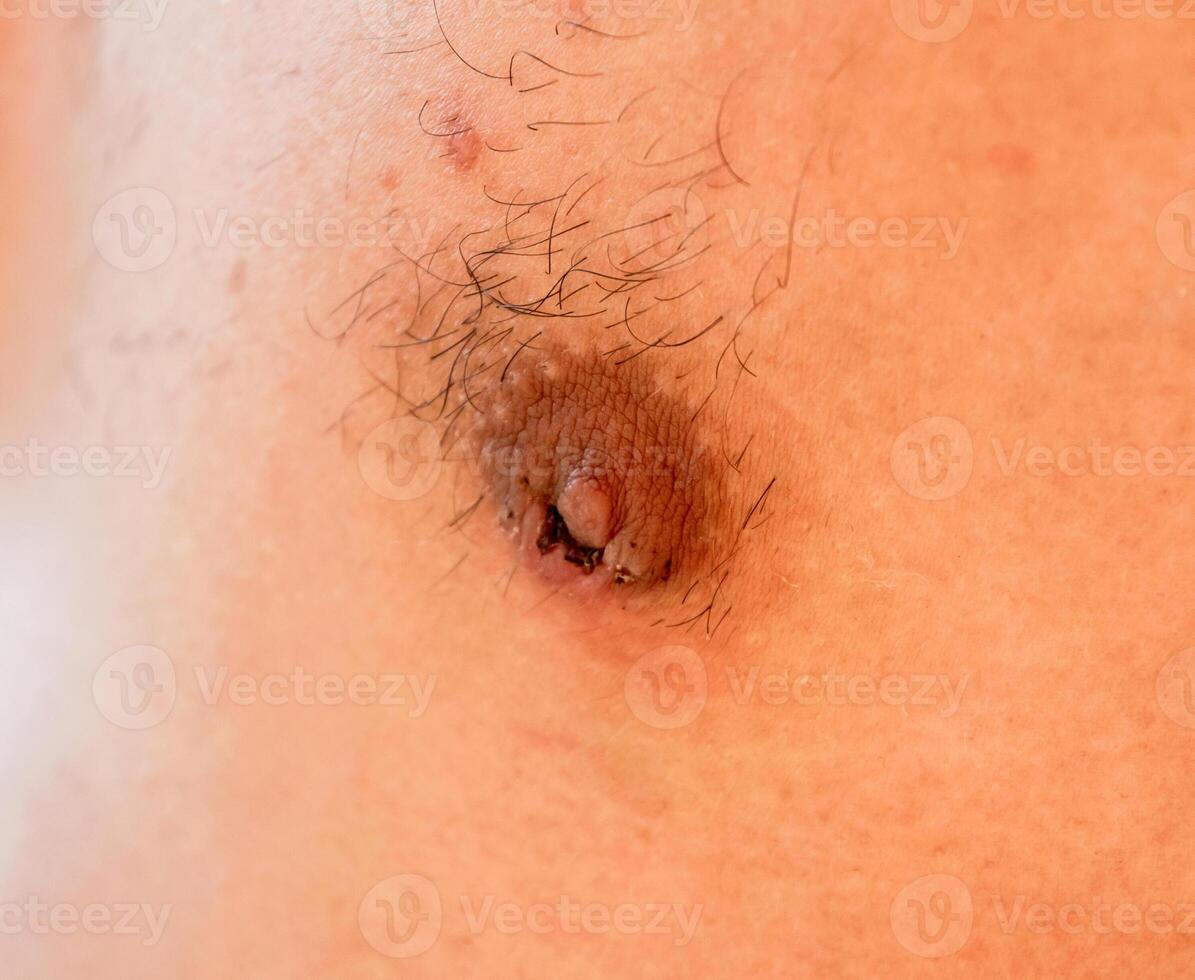 Male nipple after papilloma surgery. Healing after surgery. photo