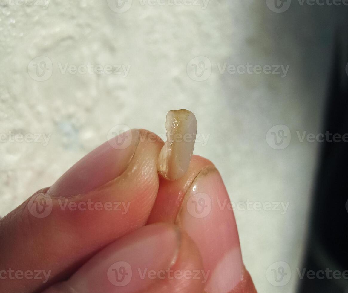 Fallen off old filling with a cutter. The seal of the tooth. photo