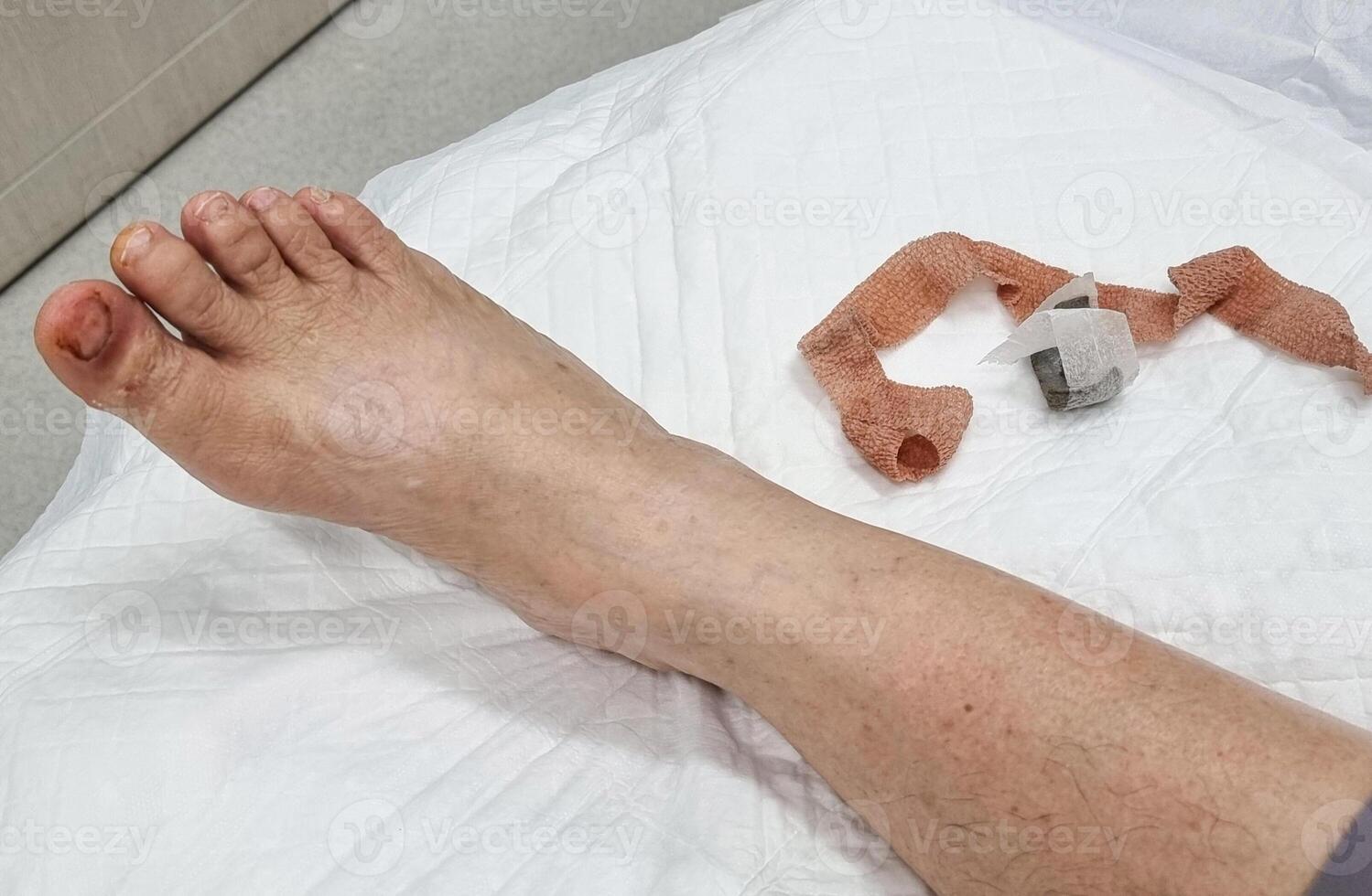 female use bandage healthy foot hurt toenail need foe medical care. finger cracked hematoma purple color on white color background. photo