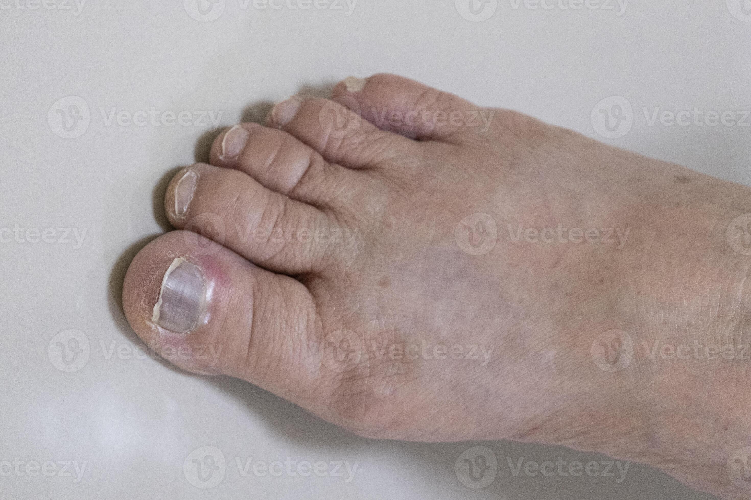 female healthy foot hurt toenail need foe medical care. finger cracked