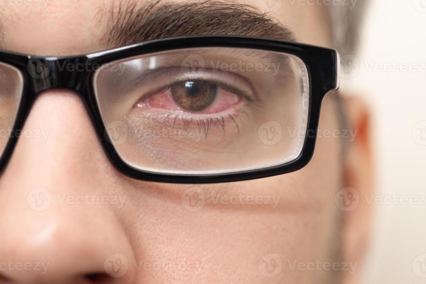 Close-up of a man in glasses with a red eye photo