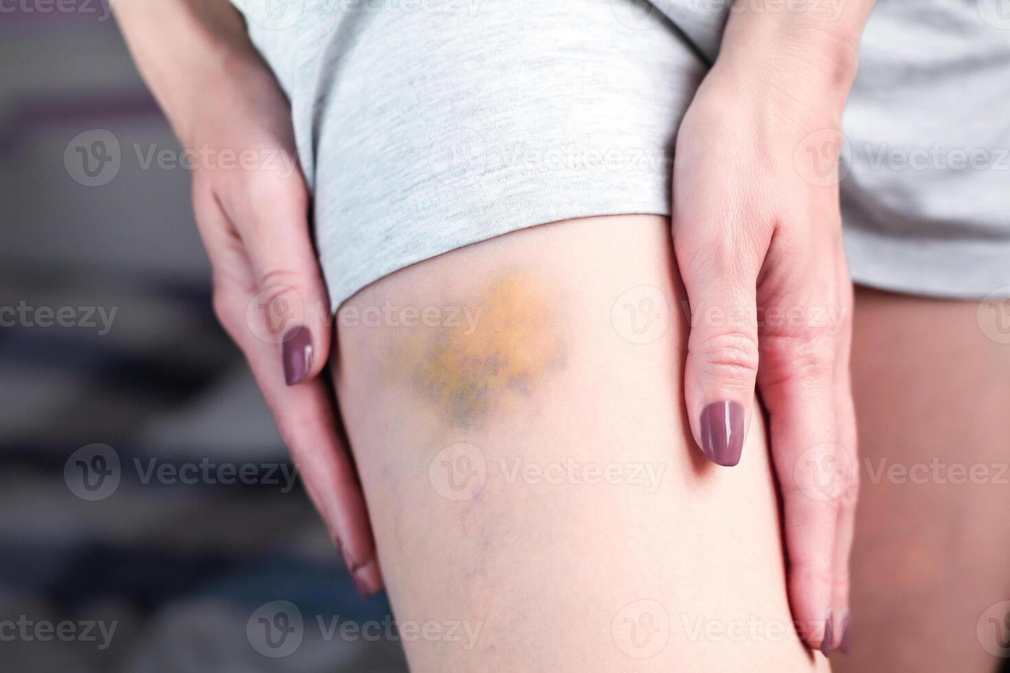 Bruise on the leg of a woman. A bruised leg. Close-up. photo